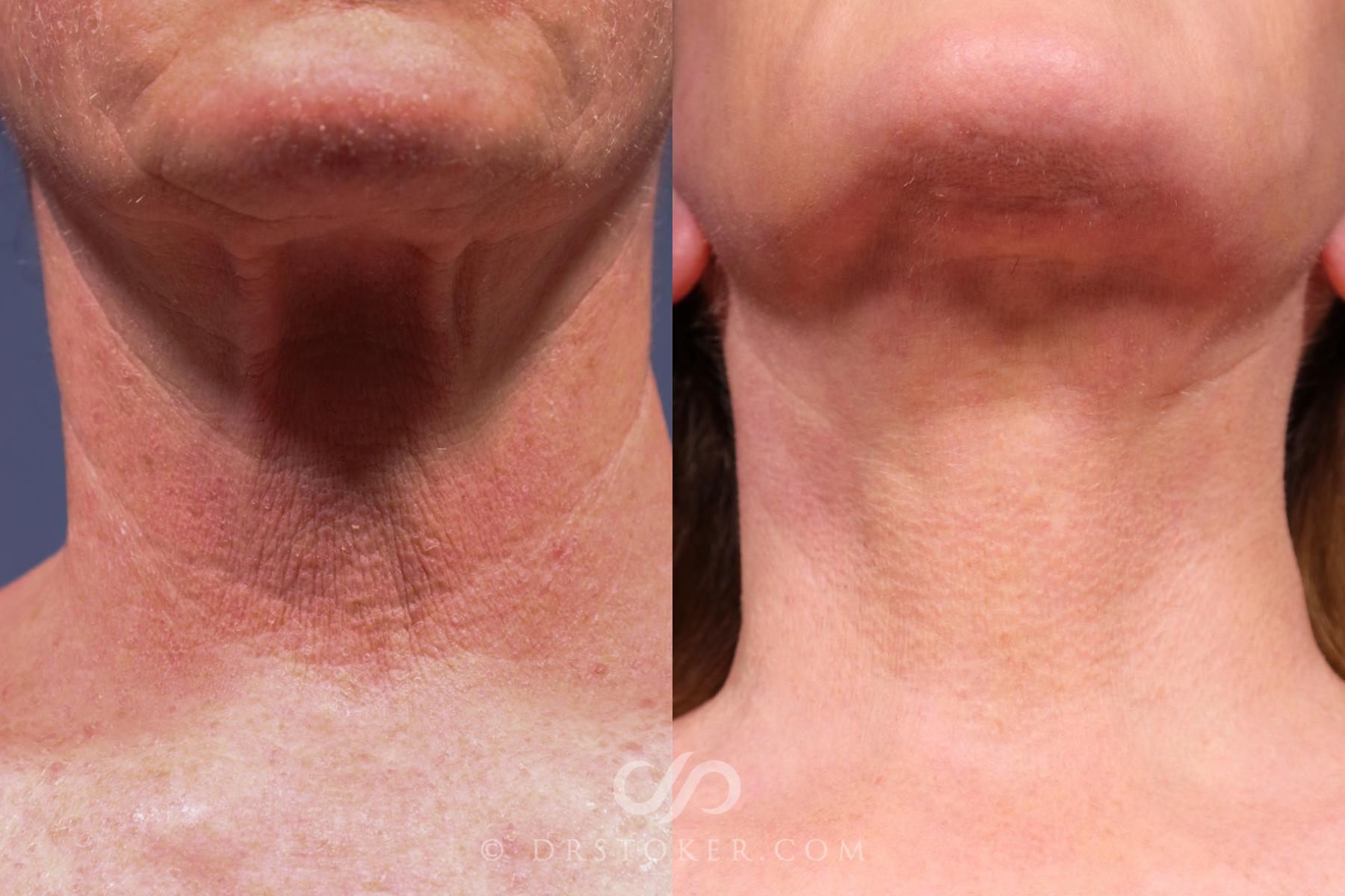 Before & After Traceless Deep Plane Facelift Case 2601 Neck View in Los Angeles, CA