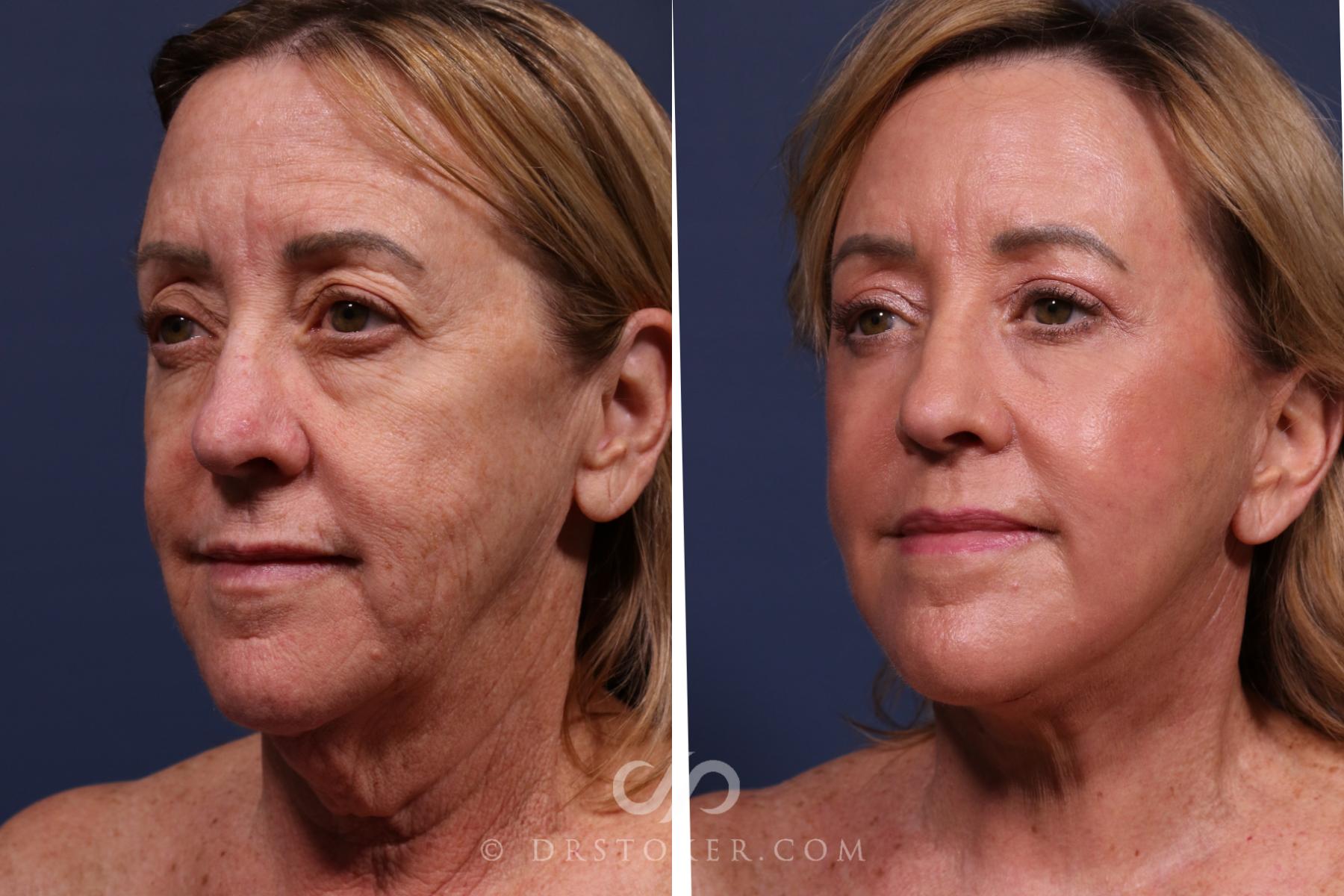 Before & After Traceless Deep Plane Facelift Case 2618 Left Oblique View in Los Angeles, CA