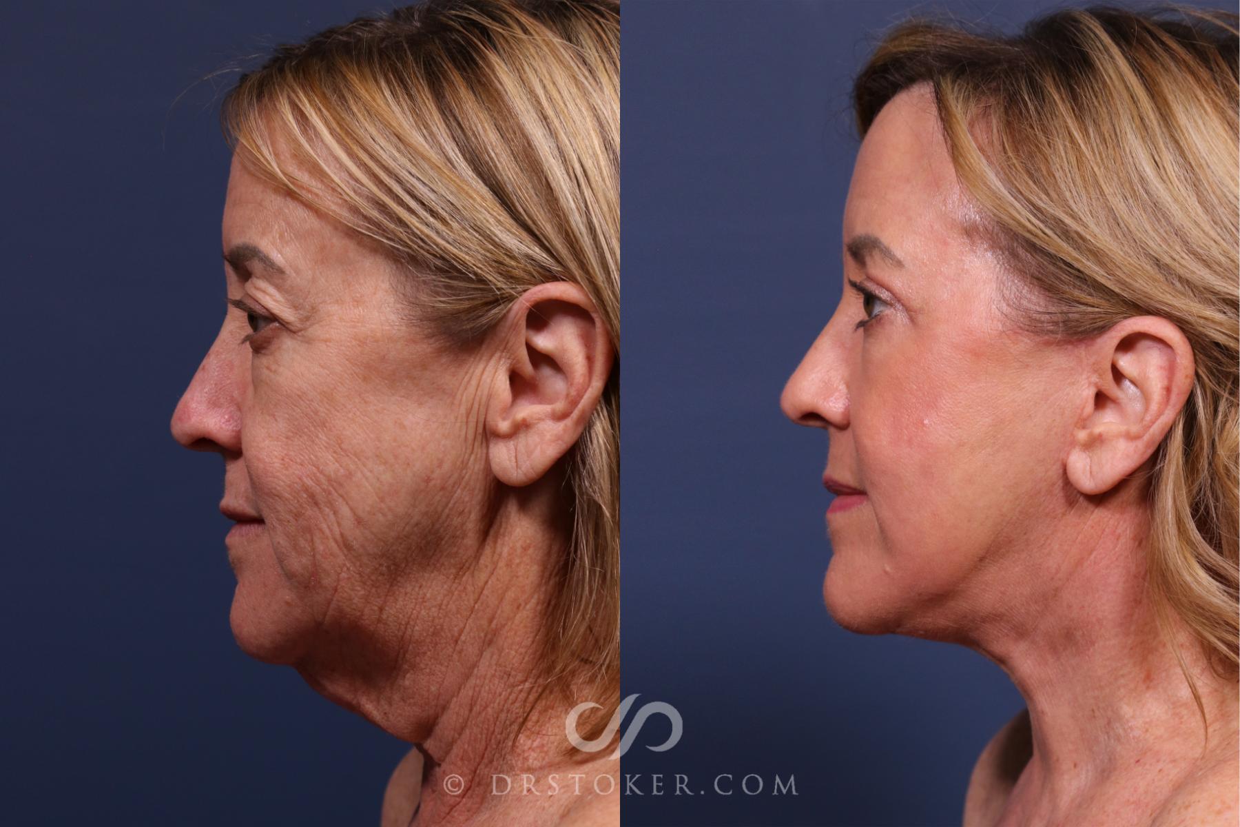 Before & After Traceless Deep Plane Facelift Case 2618 Left Side View in Los Angeles, CA