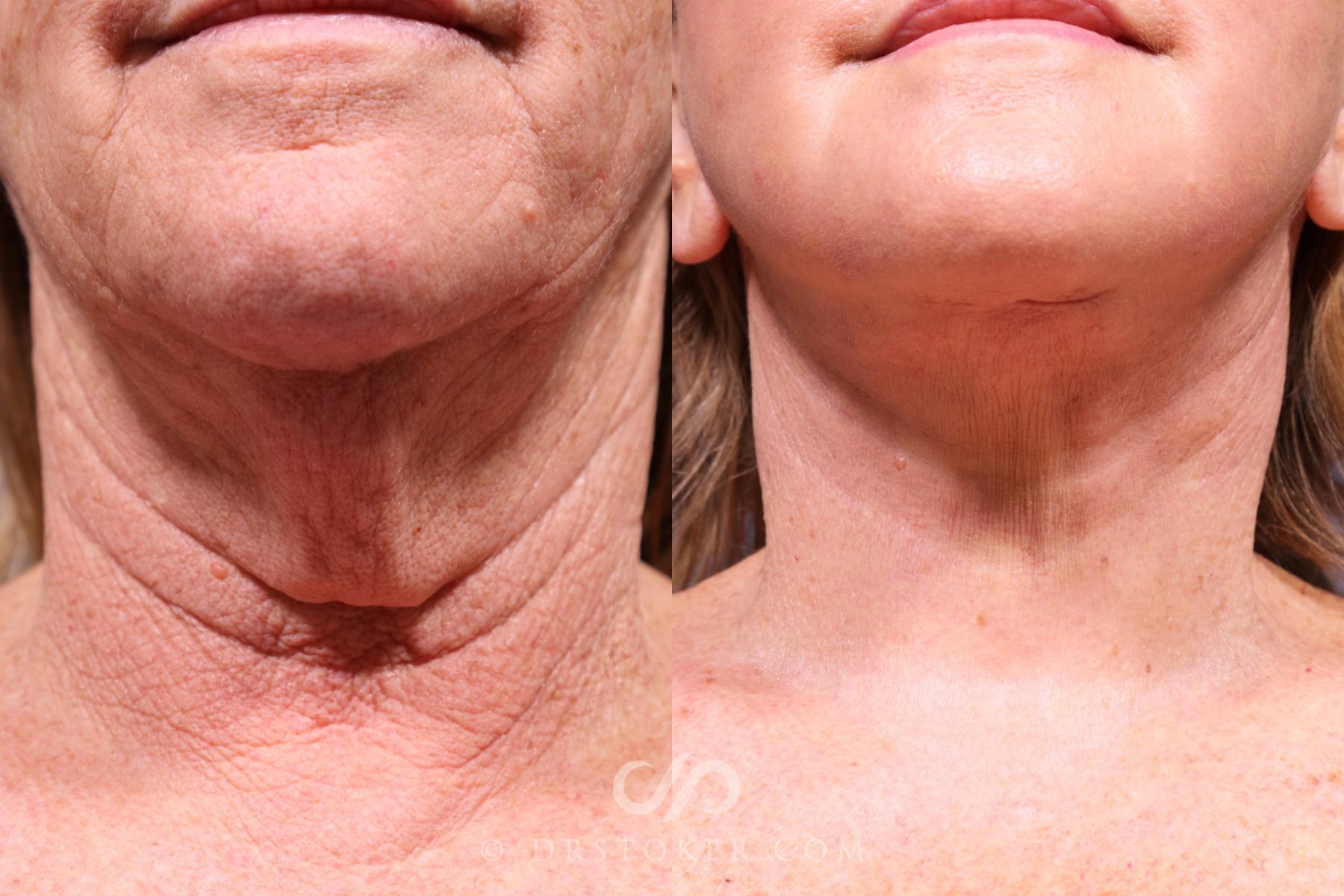 Before & After Traceless Deep Plane Facelift Case 2618 Neck View in Los Angeles, CA