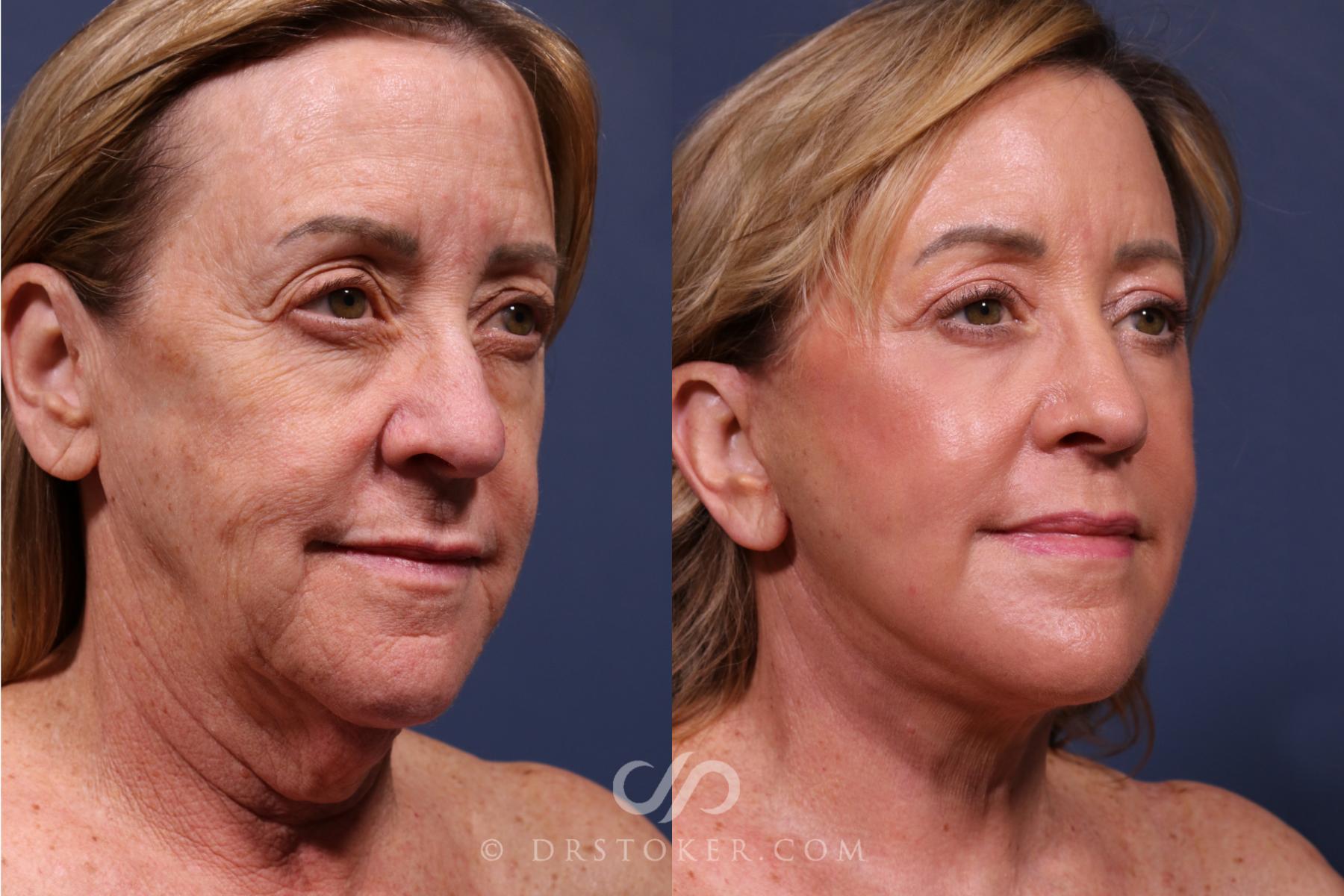 Before & After Traceless Deep Plane Facelift Case 2618 Right Oblique View in Los Angeles, CA