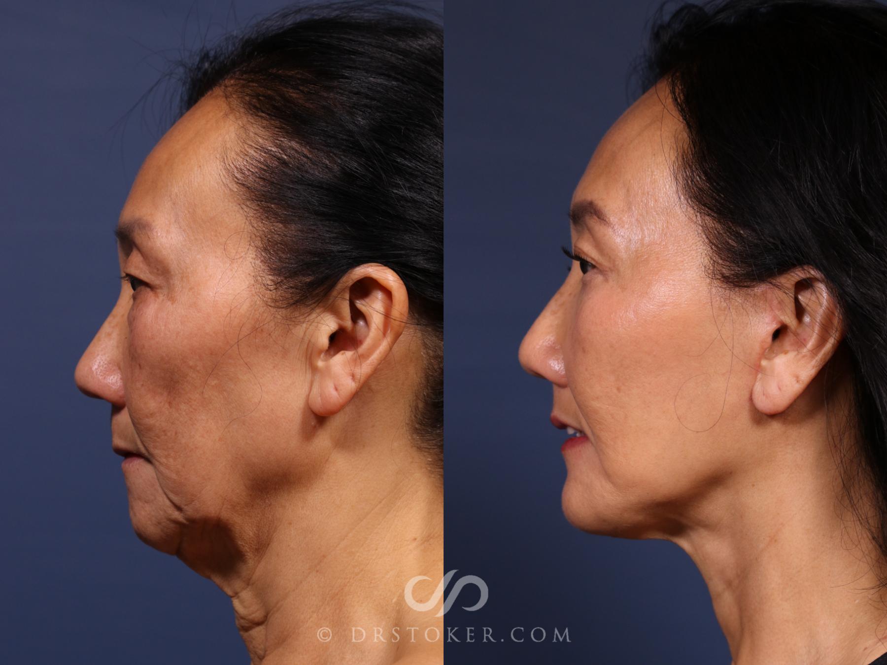 Before & After Traceless Deep Plane Facelift Case 2621 Left Oblique View in Los Angeles, CA