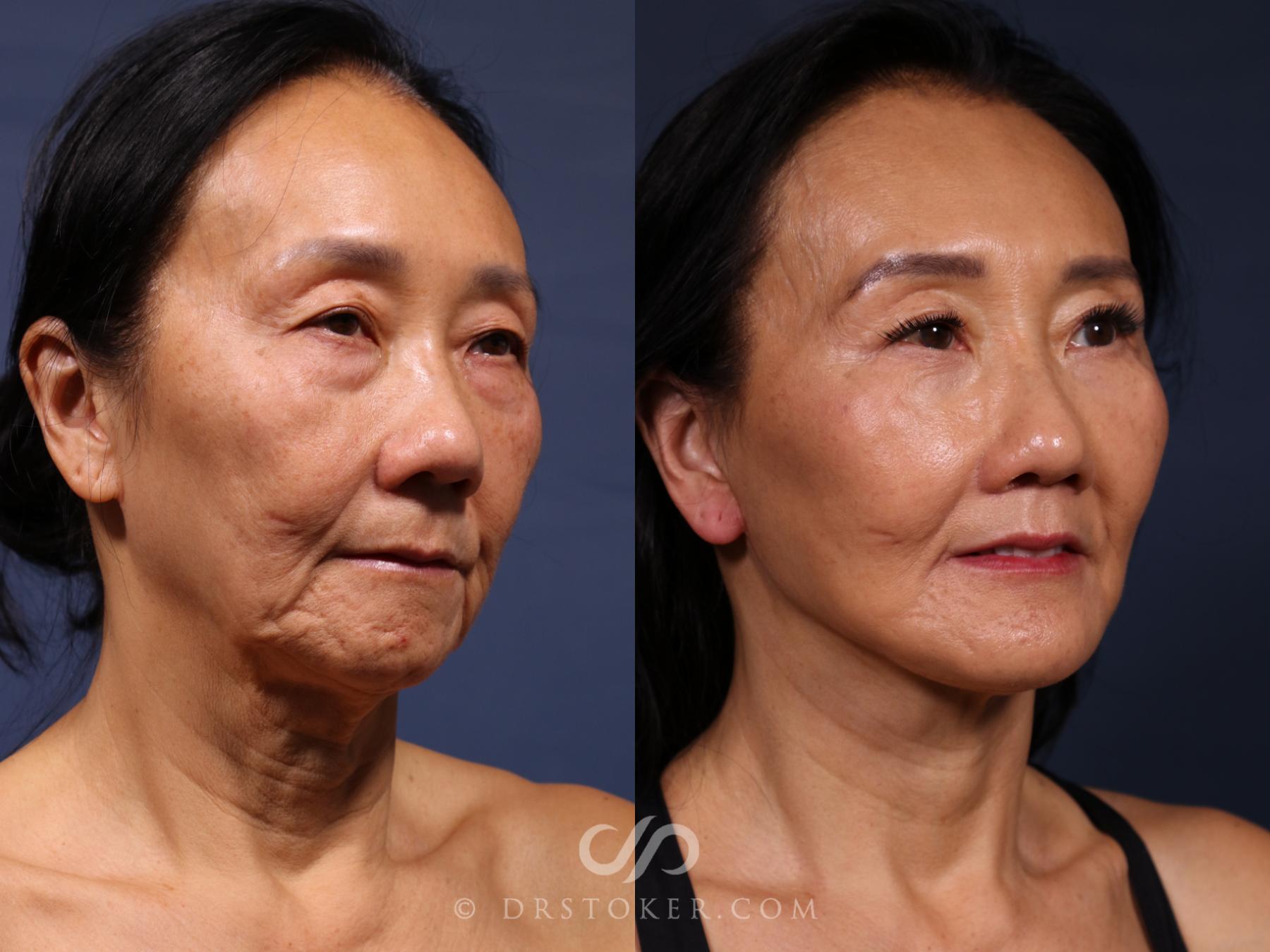 Before & After Traceless Deep Plane Facelift Case 2621 Right Oblique View in Los Angeles, CA