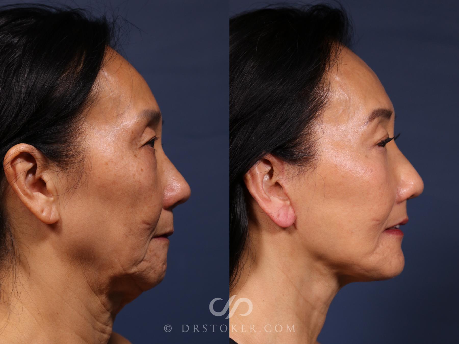 Before & After Traceless Deep Plane Facelift Case 2621 Right Side View in Los Angeles, CA