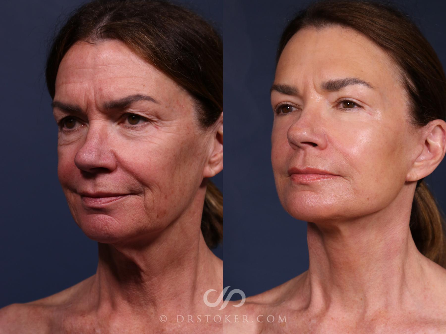 Before & After Traceless Deep Plane Facelift Case 2650 Left Oblique View in Los Angeles, CA