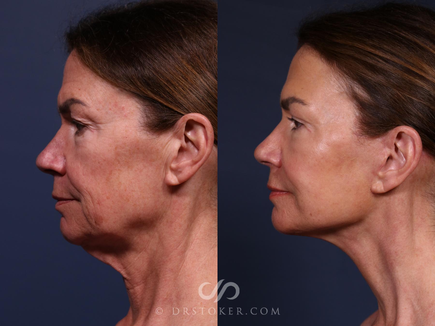 Before & After Traceless Deep Plane Facelift Case 2650 Left Side View in Los Angeles, CA