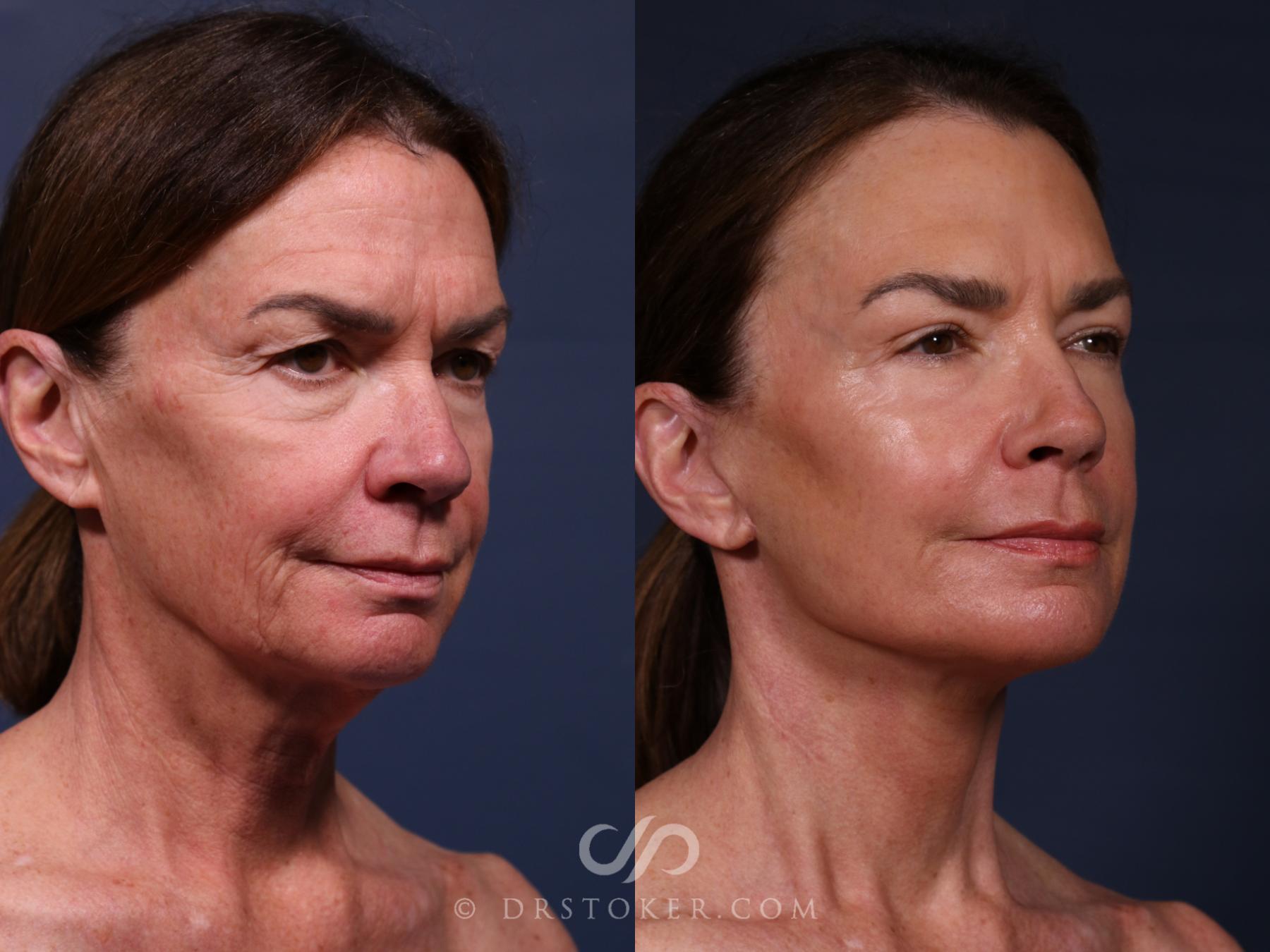Before & After Traceless Deep Plane Facelift Case 2650 Right Oblique View in Los Angeles, CA