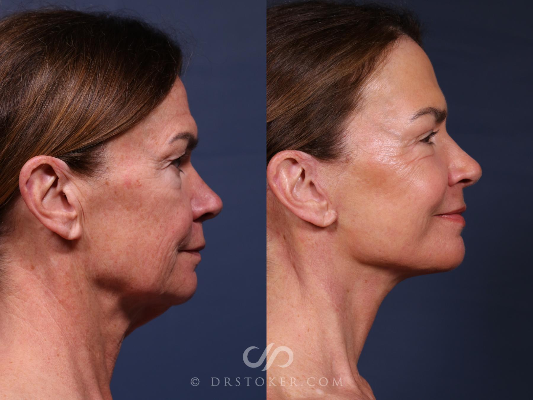 Before & After Traceless Deep Plane Facelift Case 2650 Right Side View in Los Angeles, CA