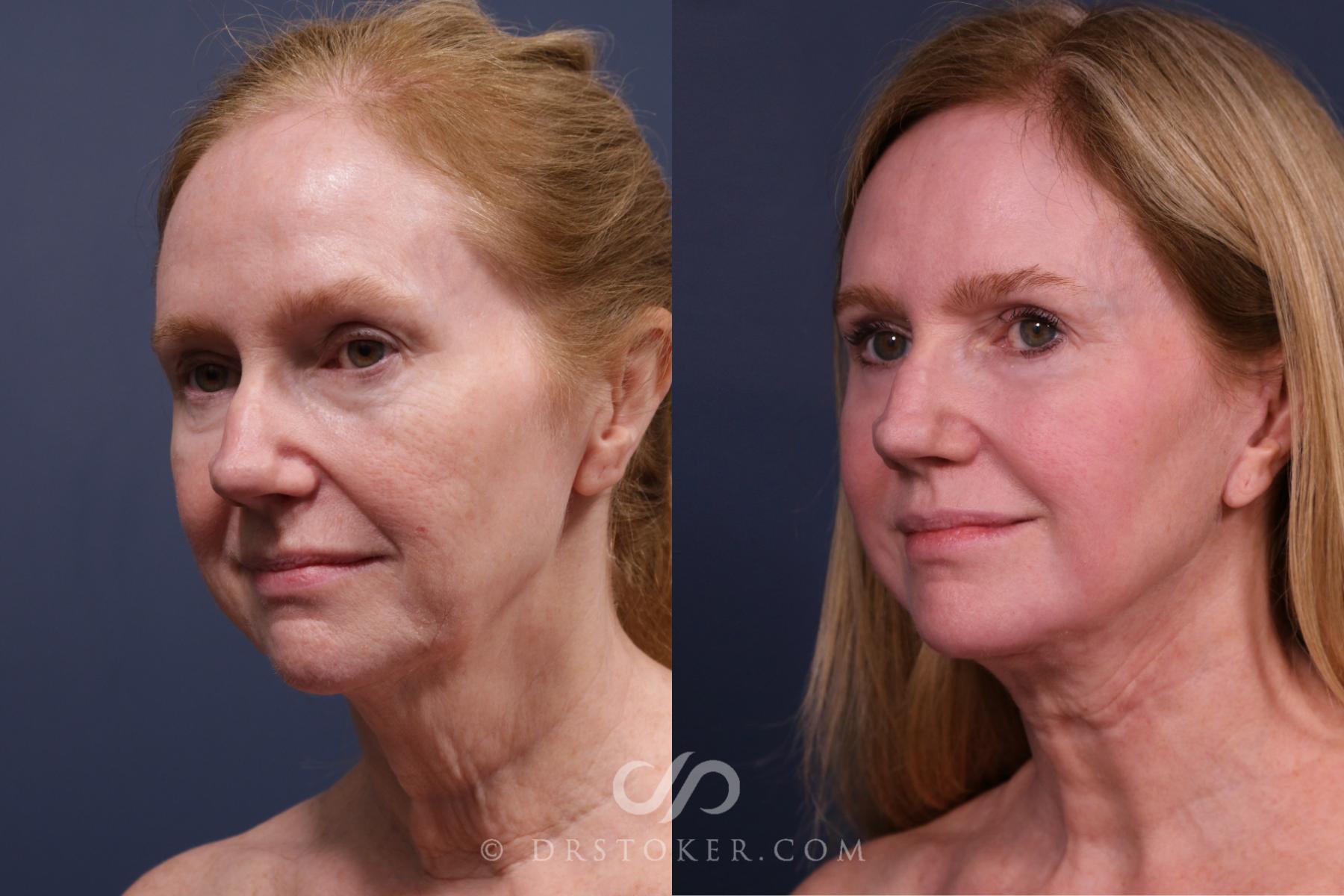 Before & After Traceless Deep Plane Facelift Case 2657 Left Oblique View in Los Angeles, CA