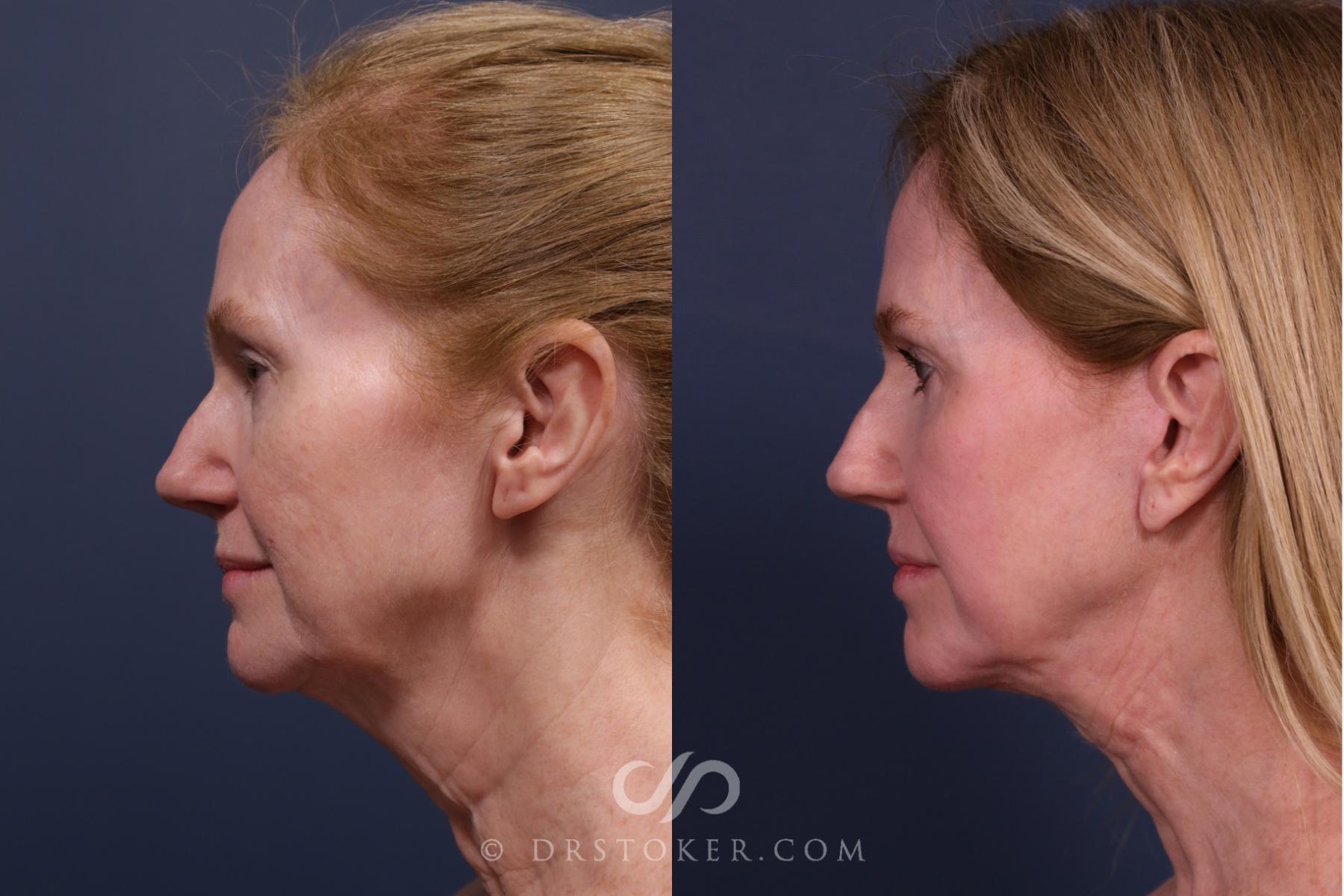 Before & After Traceless Deep Plane Facelift Case 2657 Left Side View in Los Angeles, CA