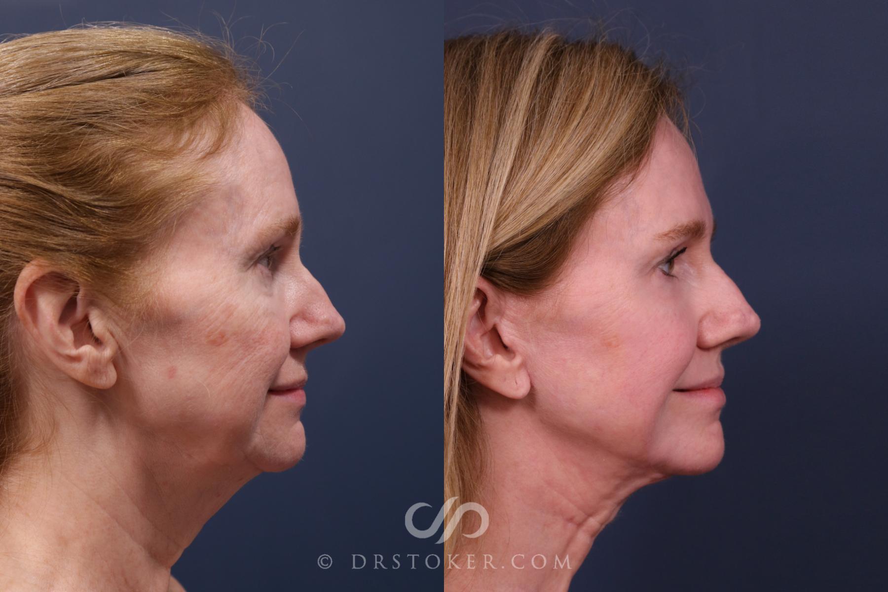 Before & After Traceless Deep Plane Facelift Case 2657 Right Side View in Los Angeles, CA