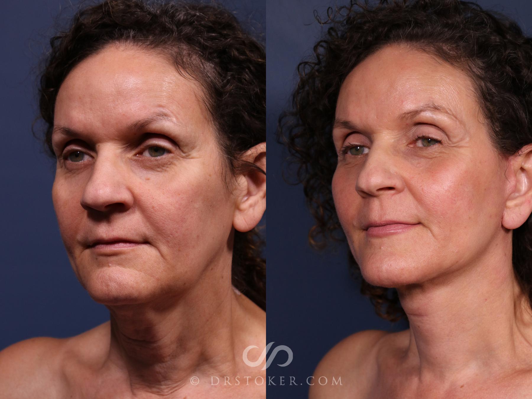 Before & After Traceless Deep Plane Facelift Case 2669 Left Oblique View in Los Angeles, CA