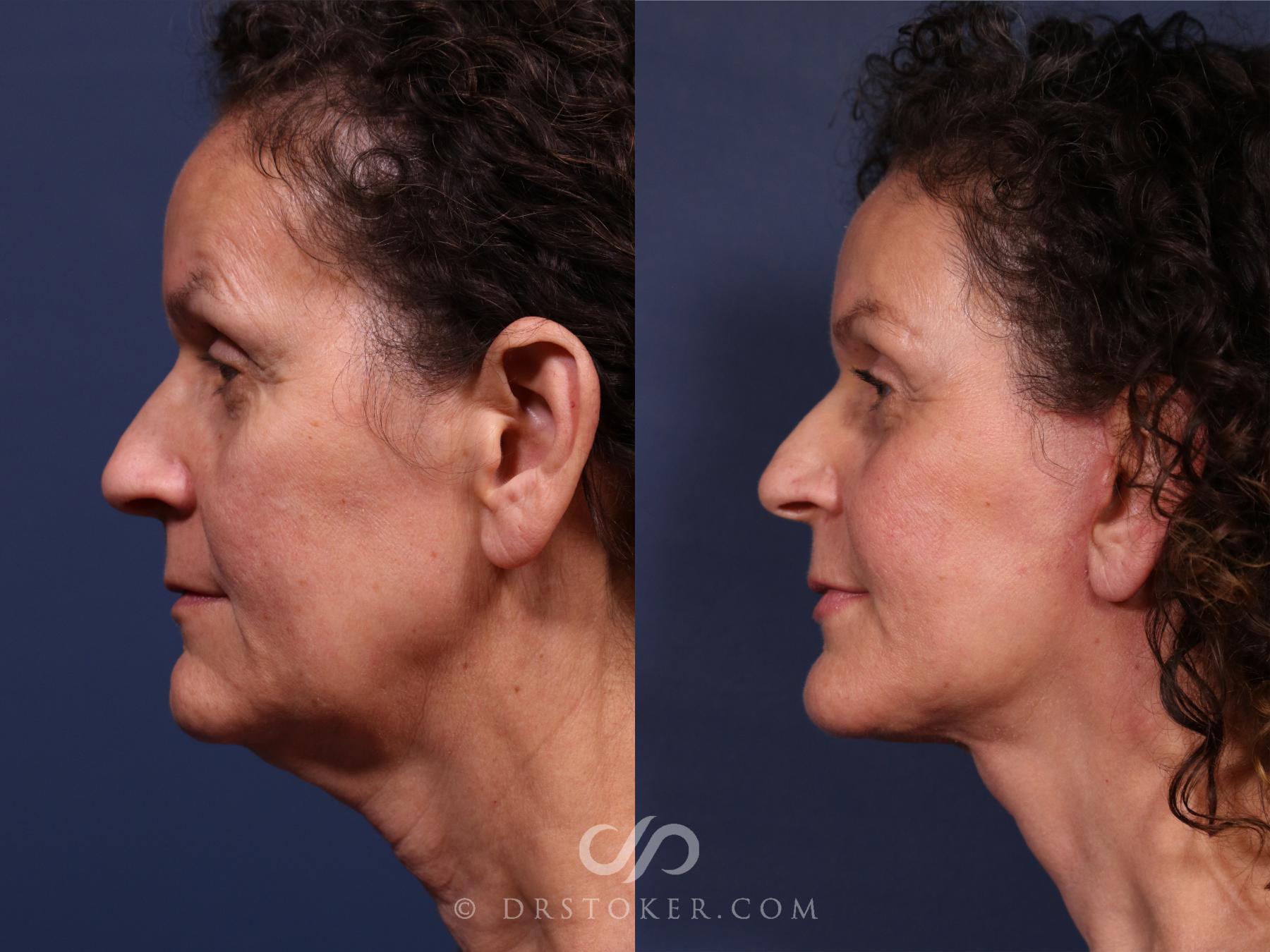 Before & After Traceless Deep Plane Facelift Case 2669 Left Side View in Los Angeles, CA