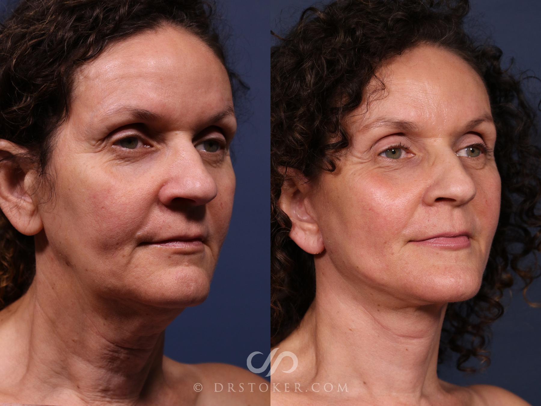 Before & After Traceless Deep Plane Facelift Case 2669 Right Oblique View in Los Angeles, CA