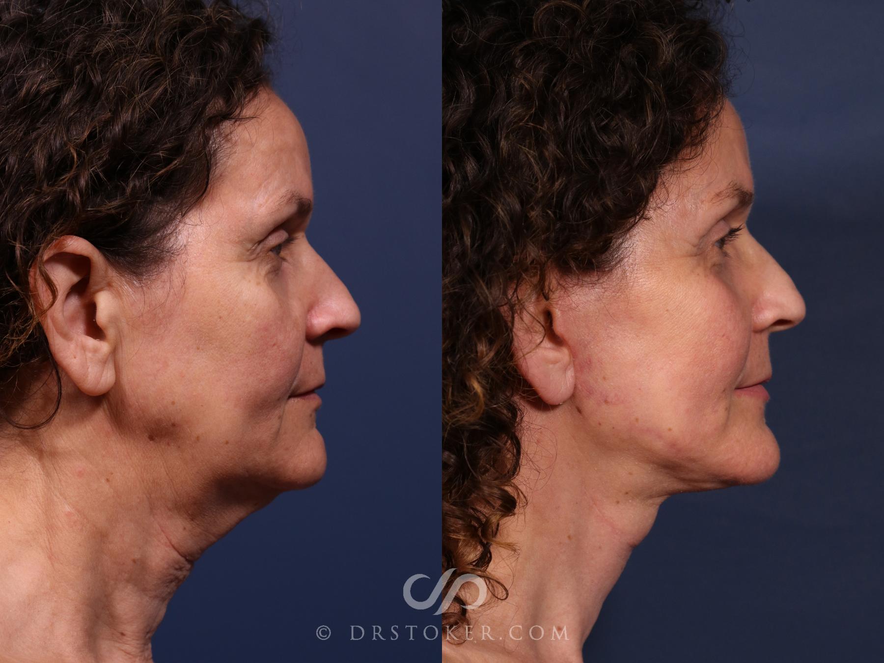 Before & After Traceless Deep Plane Facelift Case 2669 Right Side View in Los Angeles, CA