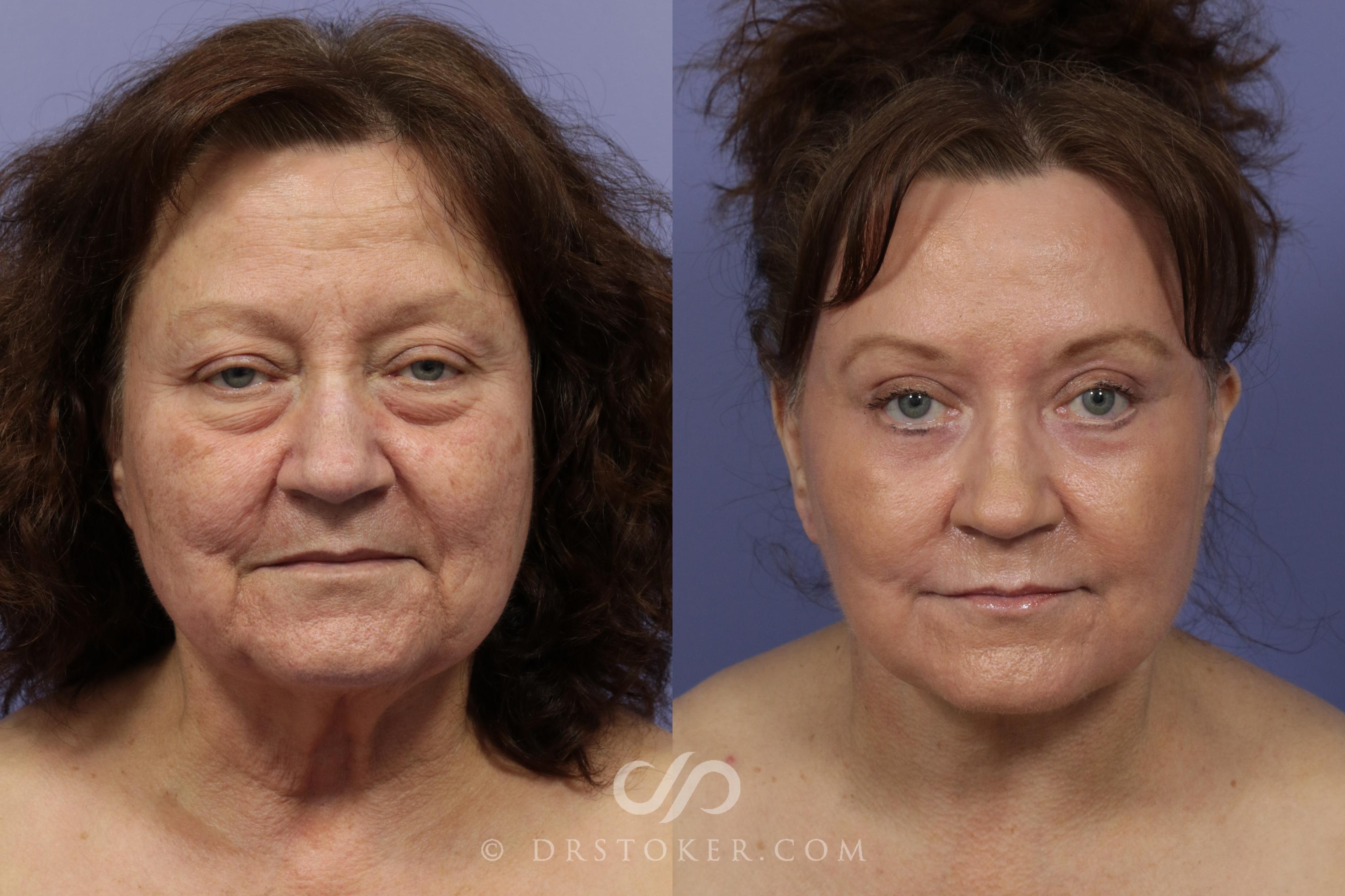 Before & After Traceless Deep Plane Facelift Case 794 View #1 View in Los Angeles, CA