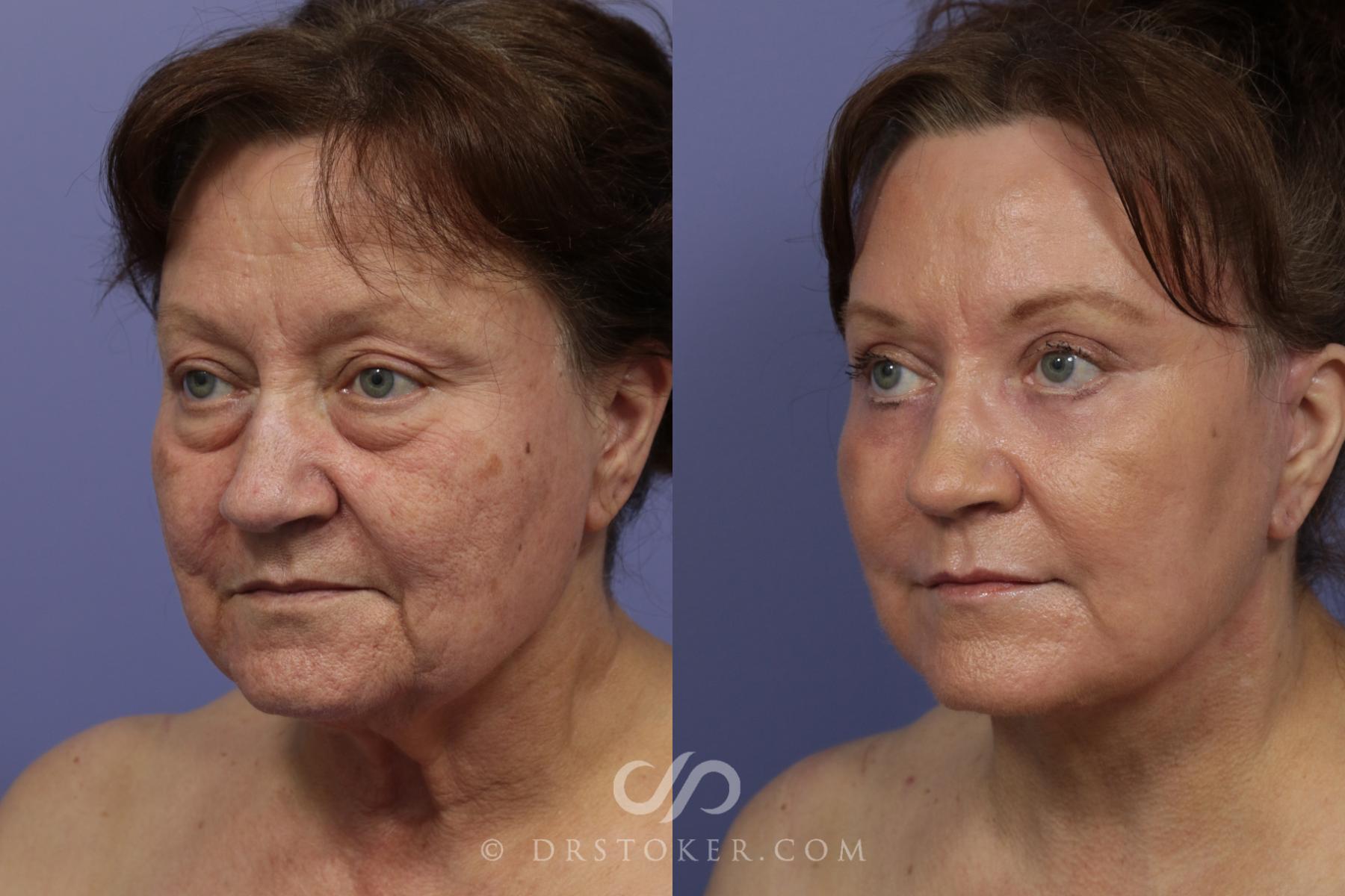 Before & After Traceless Deep Plane Facelift Case 794 View #2 View in Los Angeles, CA