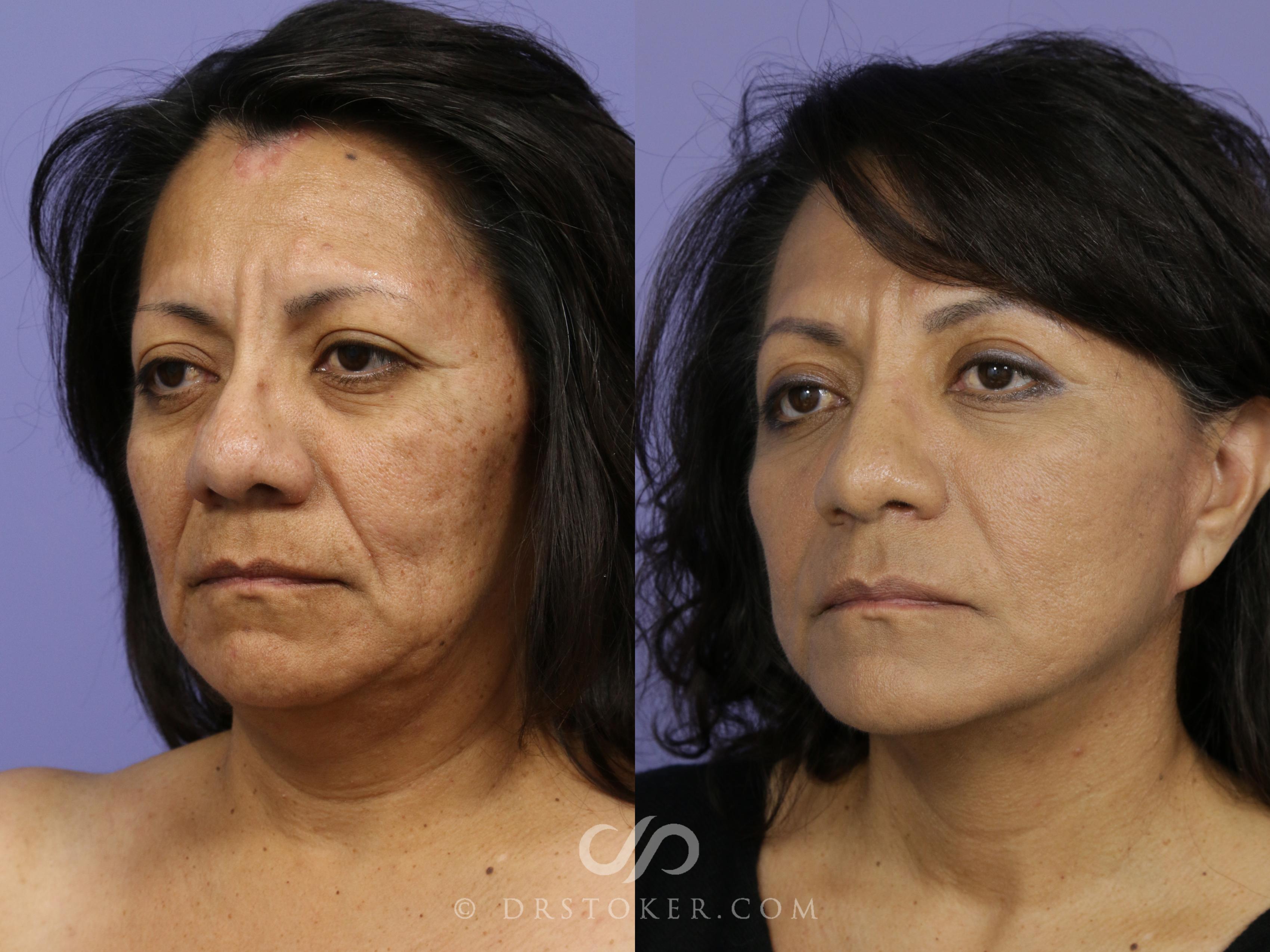 Before & After Traceless Deep Plane Facelift Case 812 View #2 View in Los Angeles, CA