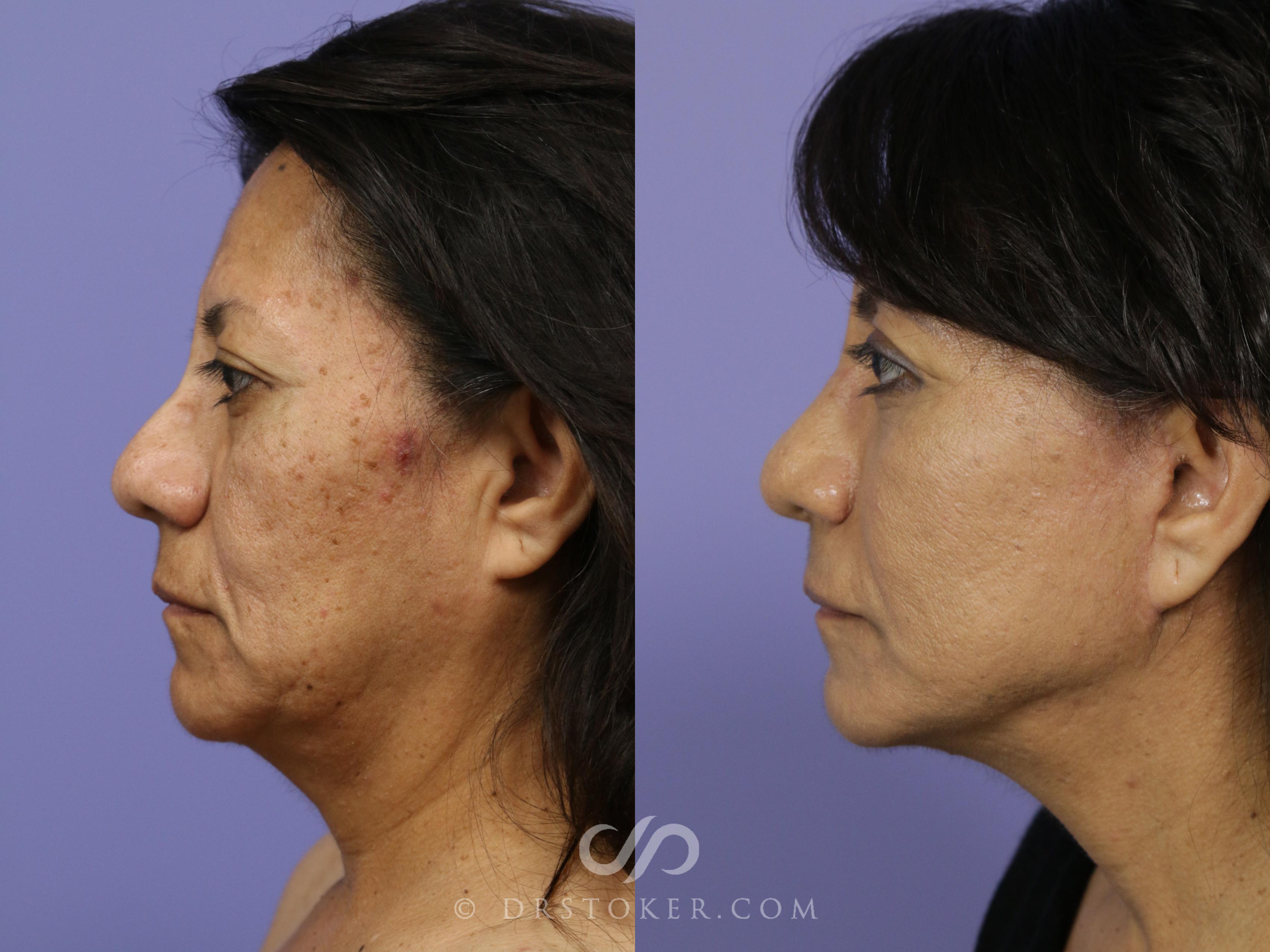 Before & After Traceless Deep Plane Facelift Case 812 View #3 View in Los Angeles, CA
