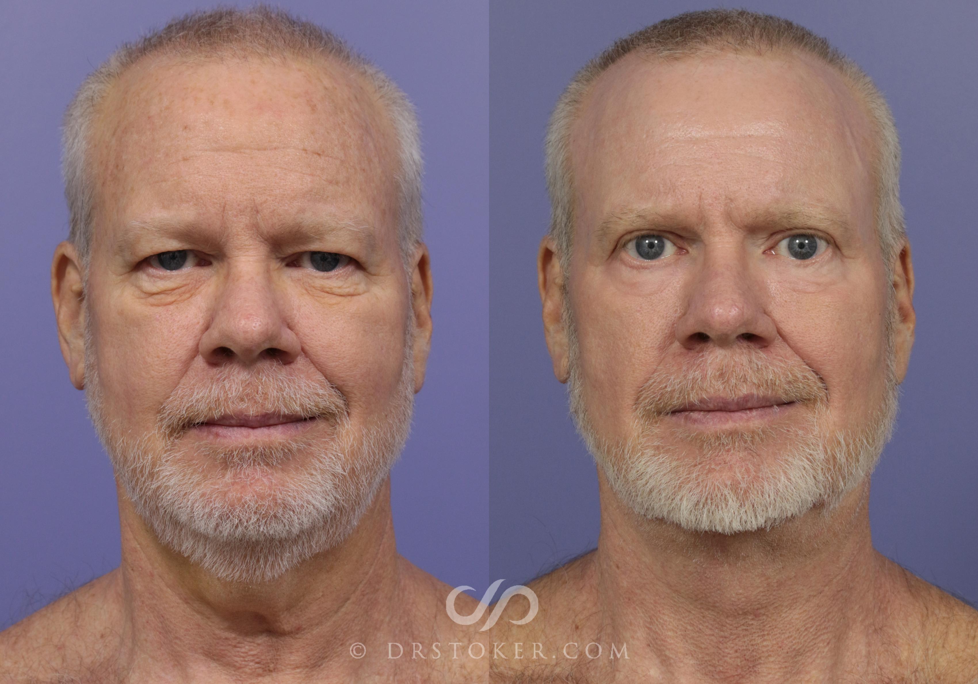 Before & After Traceless Deep Plane Facelift Case 833 View #1 View in Los Angeles, CA
