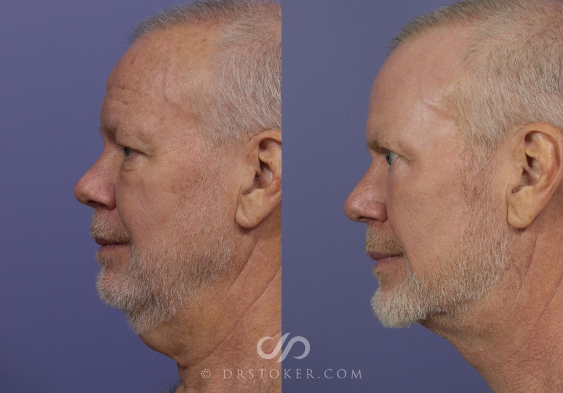 Before & After Traceless Deep Plane Facelift Case 833 View #2 View in Los Angeles, CA