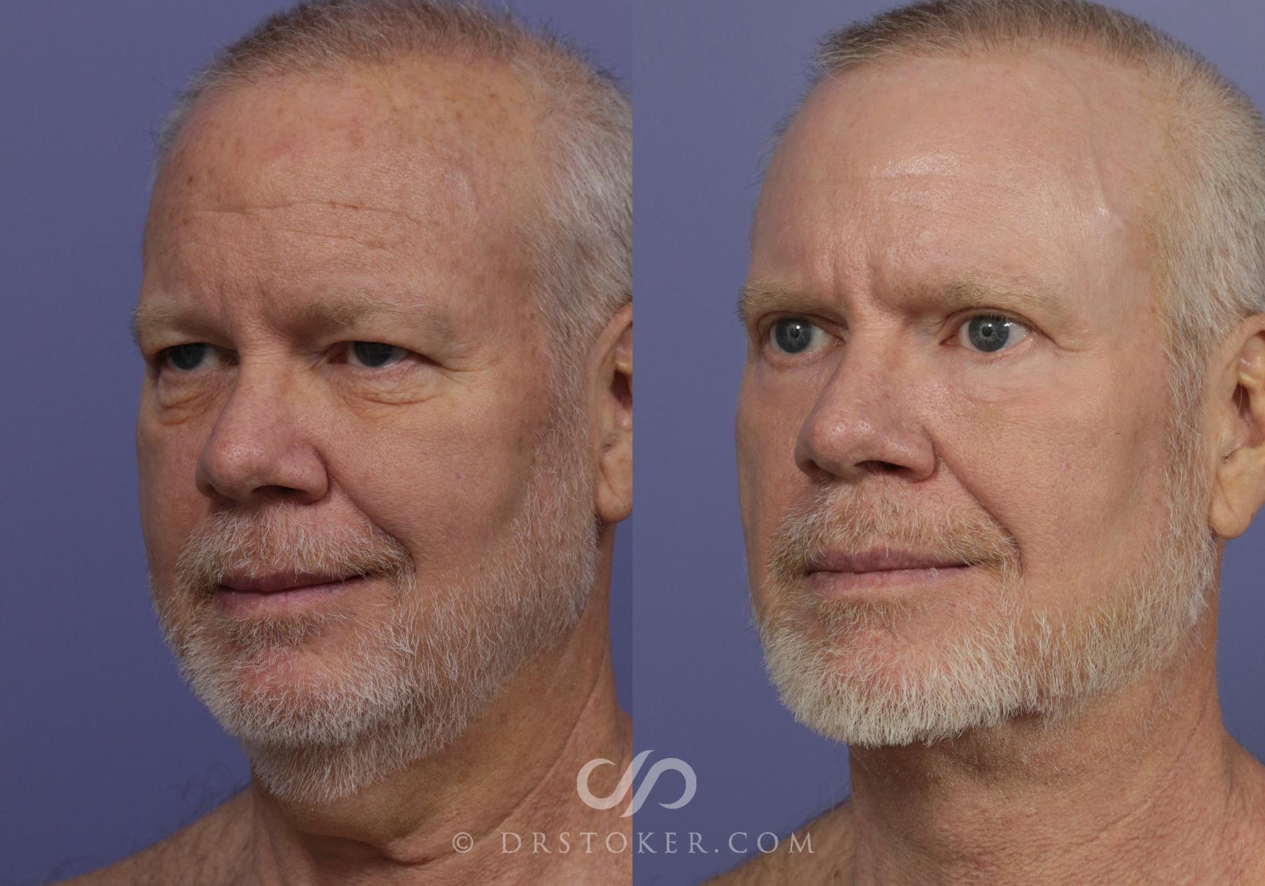 Before & After Traceless Deep Plane Facelift Case 833 View #3 View in Los Angeles, CA