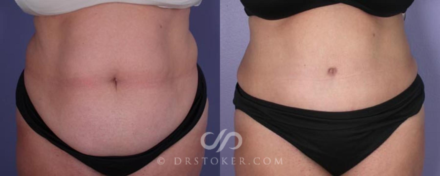 Before & After Tummy Tuck Case 1 View #1 View in Los Angeles, CA