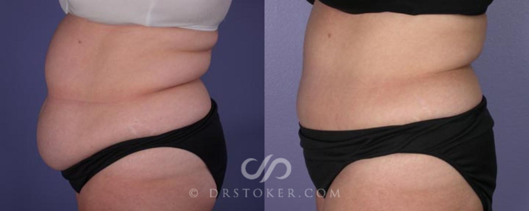 Before & After Tummy Tuck Case 1 View #2 View in Los Angeles, CA