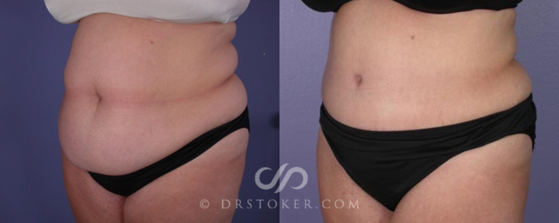 Before & After Tummy Tuck Case 1 View #3 View in Los Angeles, CA