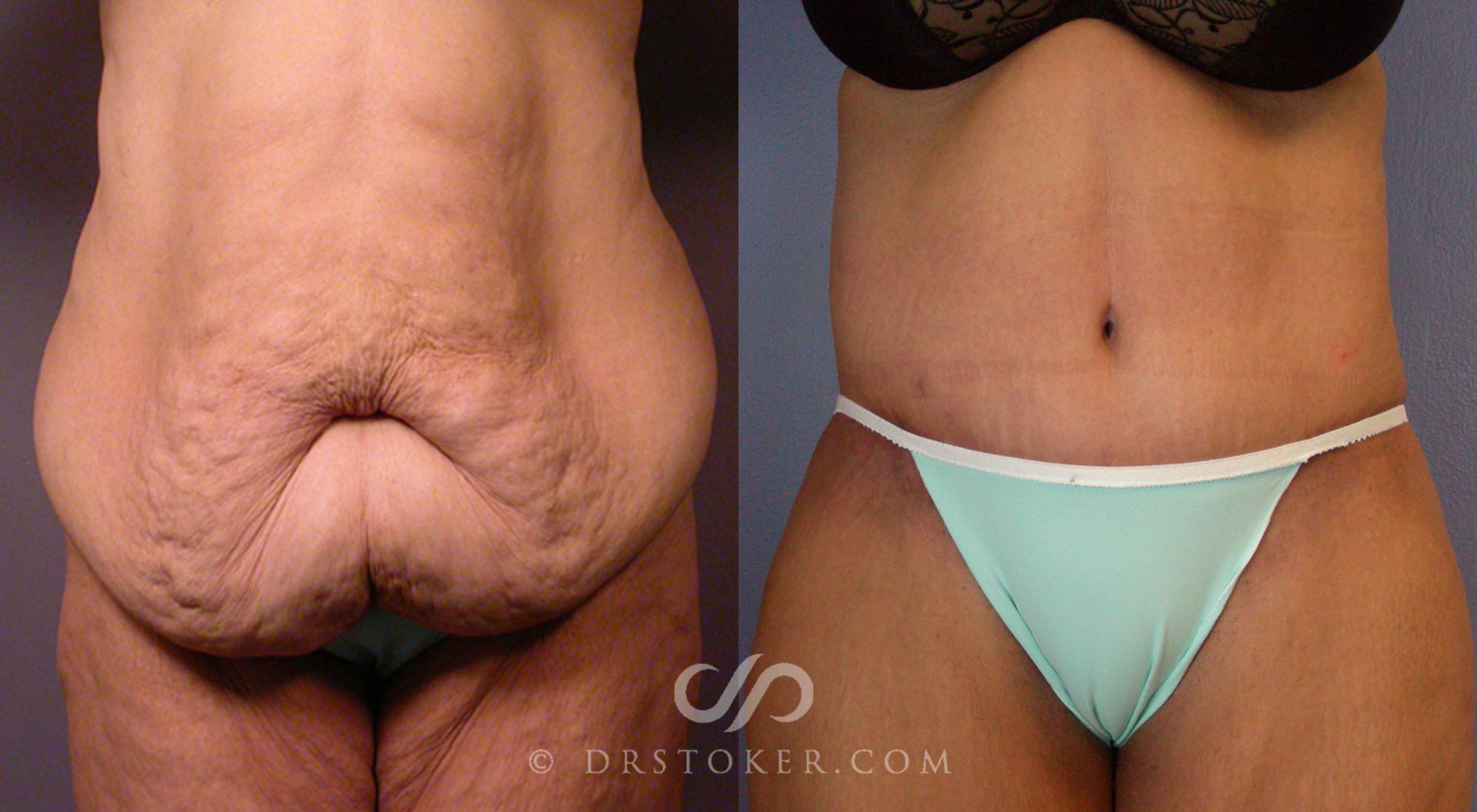 Before & After Tummy Tuck Case 101 View #1 View in Los Angeles, CA