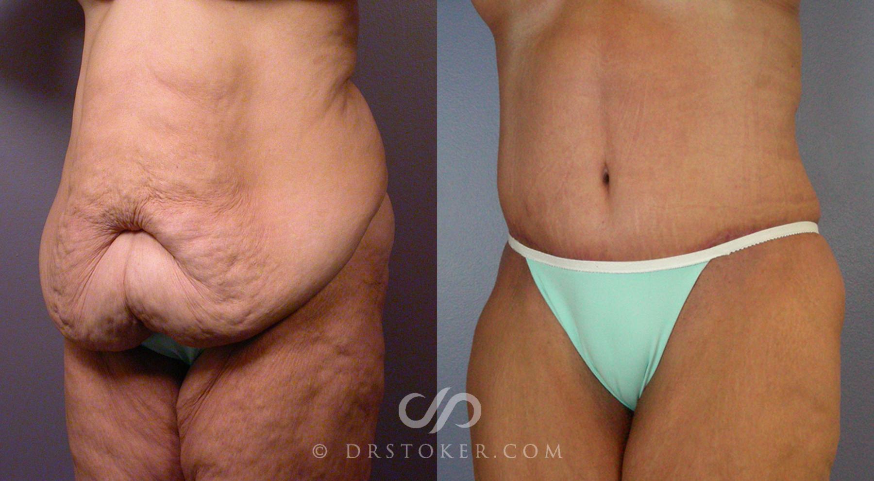 Before & After After Weight Loss Case 101 View #2 View in Los Angeles, CA