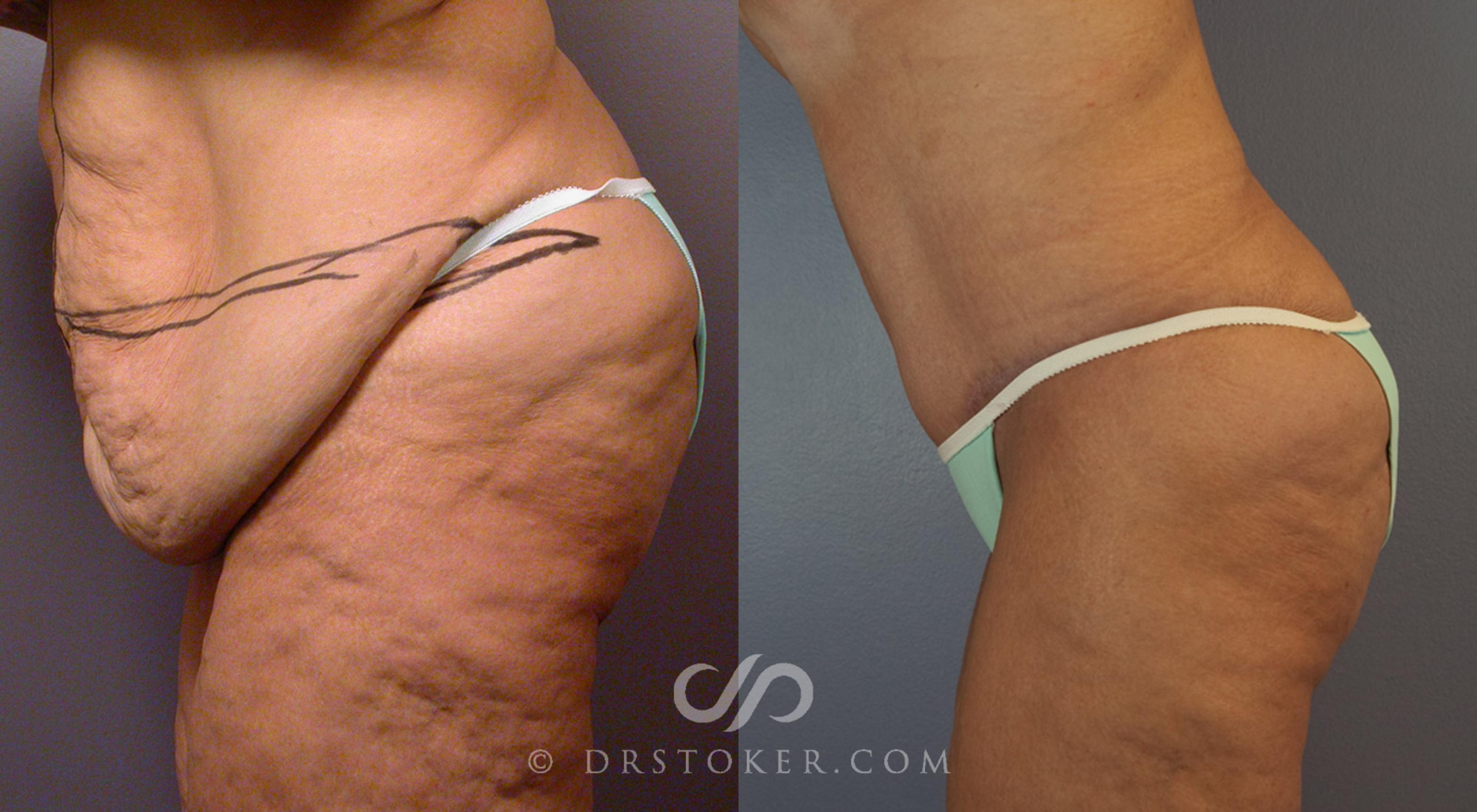 Before & After Tummy Tuck Case 101 View #3 View in Los Angeles, CA