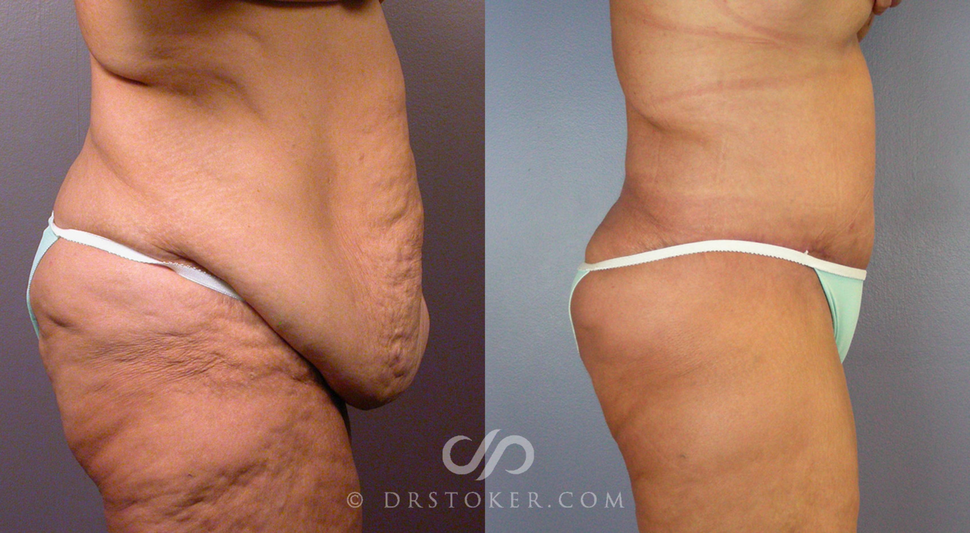 Before & After Tummy Tuck Case 101 View #4 View in Los Angeles, CA