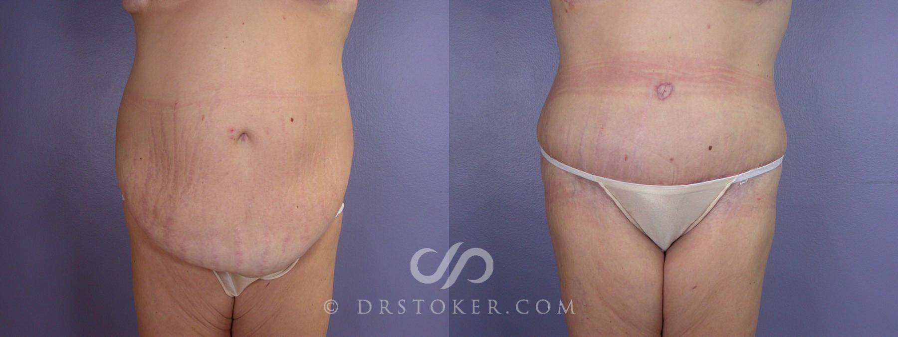 Before & After Tummy Tuck Case 116 View #1 View in Los Angeles, CA