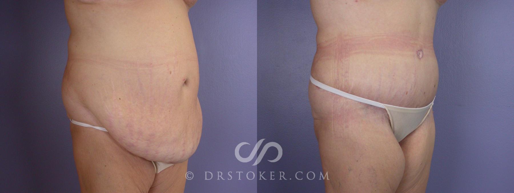 Before & After Tummy Tuck Case 116 View #2 View in Los Angeles, CA