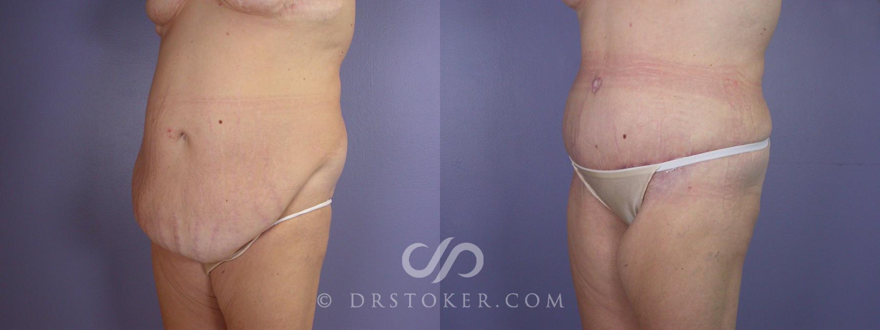 Before & After Tummy Tuck Case 116 View #3 View in Los Angeles, CA