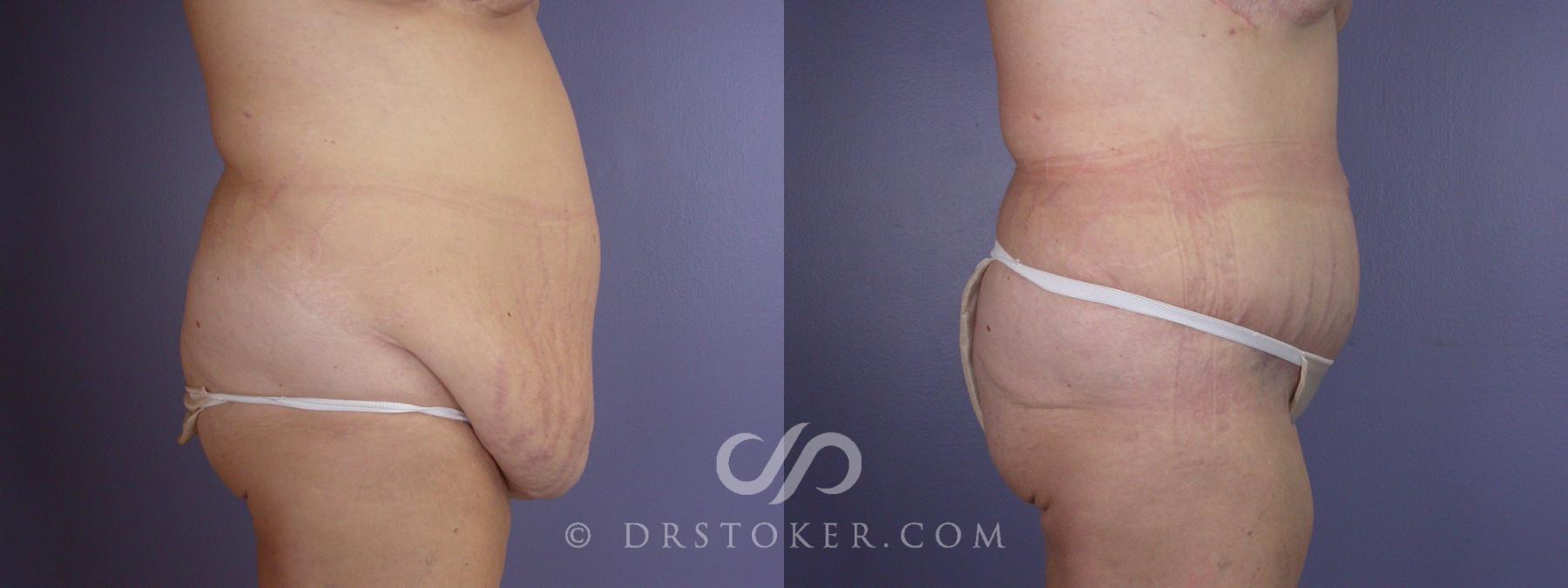 Before & After Tummy Tuck Case 116 View #4 View in Los Angeles, CA