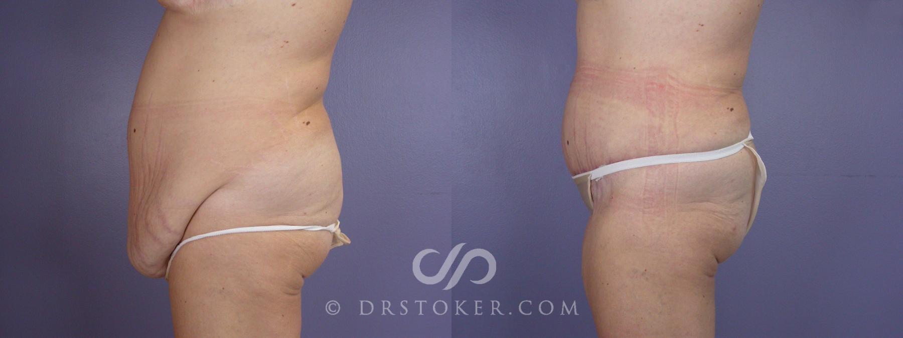 Before & After Tummy Tuck Case 116 View #5 View in Los Angeles, CA