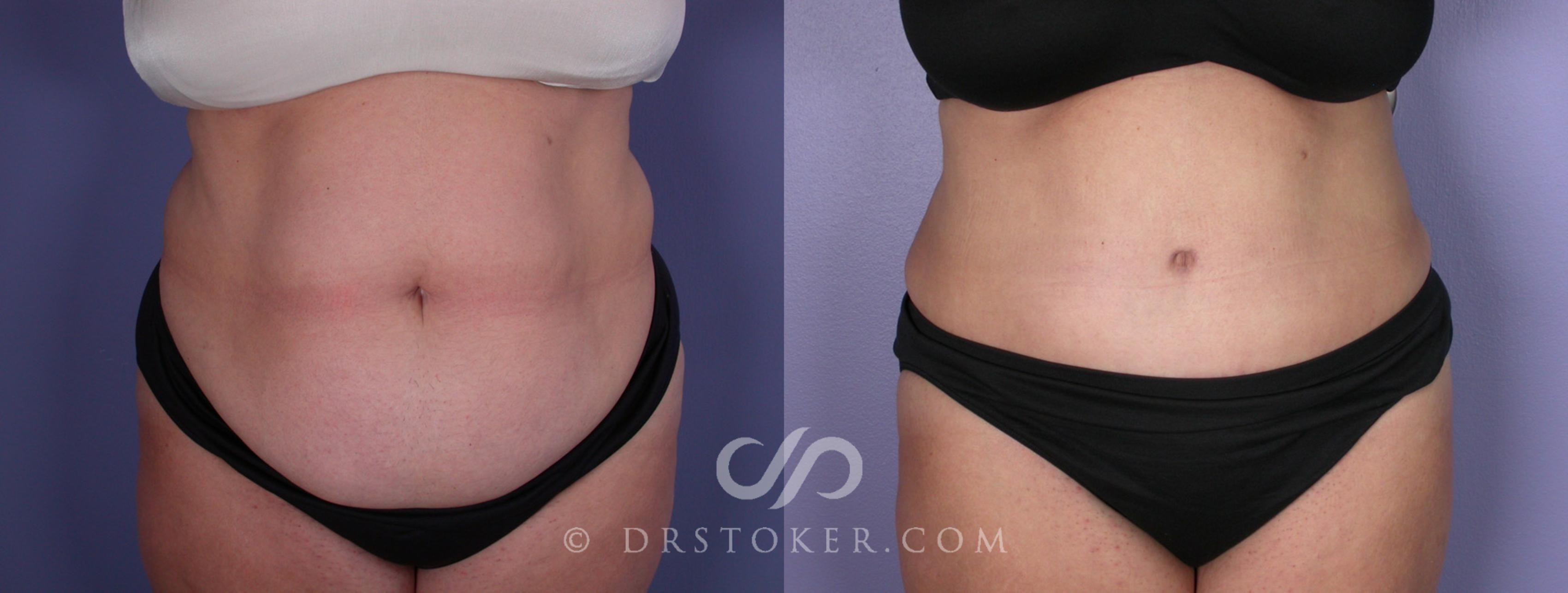 Before & After Tummy Tuck Case 117 View #1 View in Los Angeles, CA