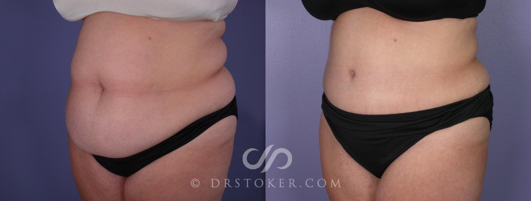 Before & After Tummy Tuck Case 117 View #2 View in Los Angeles, CA