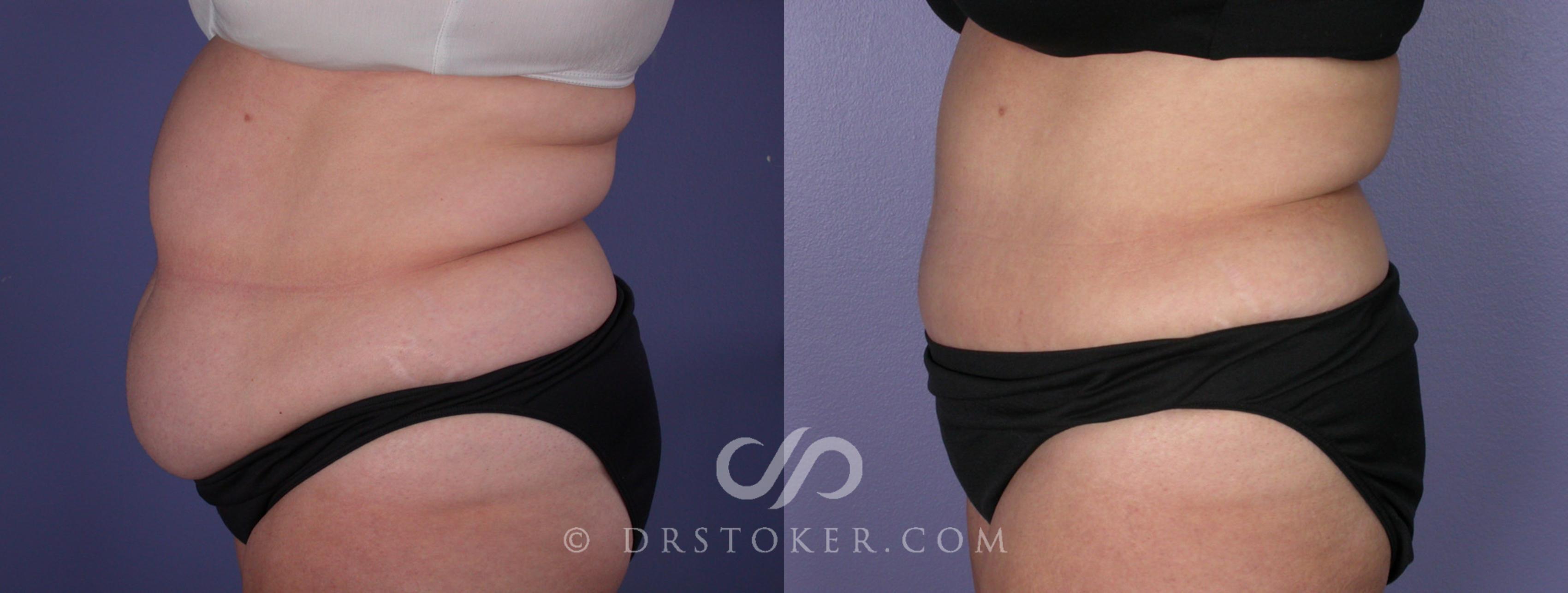 Before & After Tummy Tuck Case 117 View #3 View in Los Angeles, CA