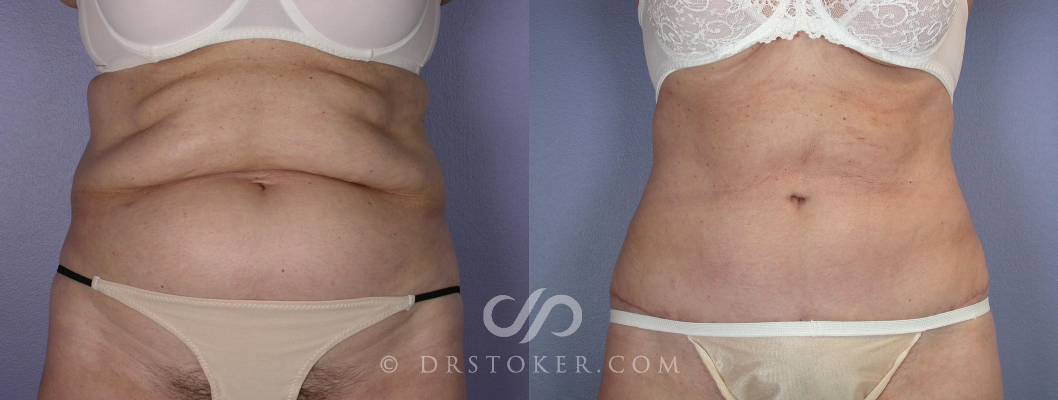 Before & After Tummy Tuck Case 118 View #1 View in Los Angeles, CA