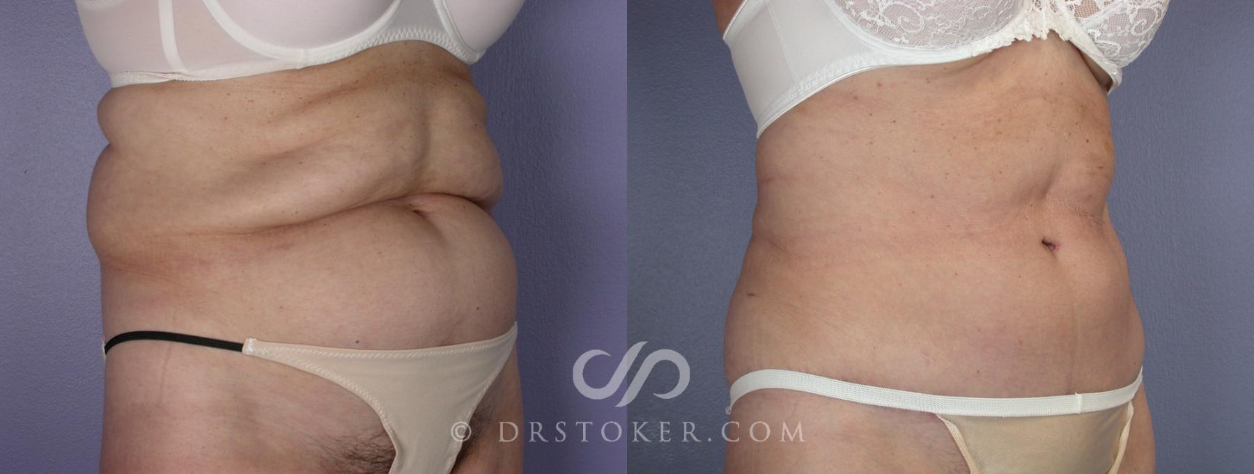 Before & After Tummy Tuck Case 118 View #2 View in Los Angeles, CA