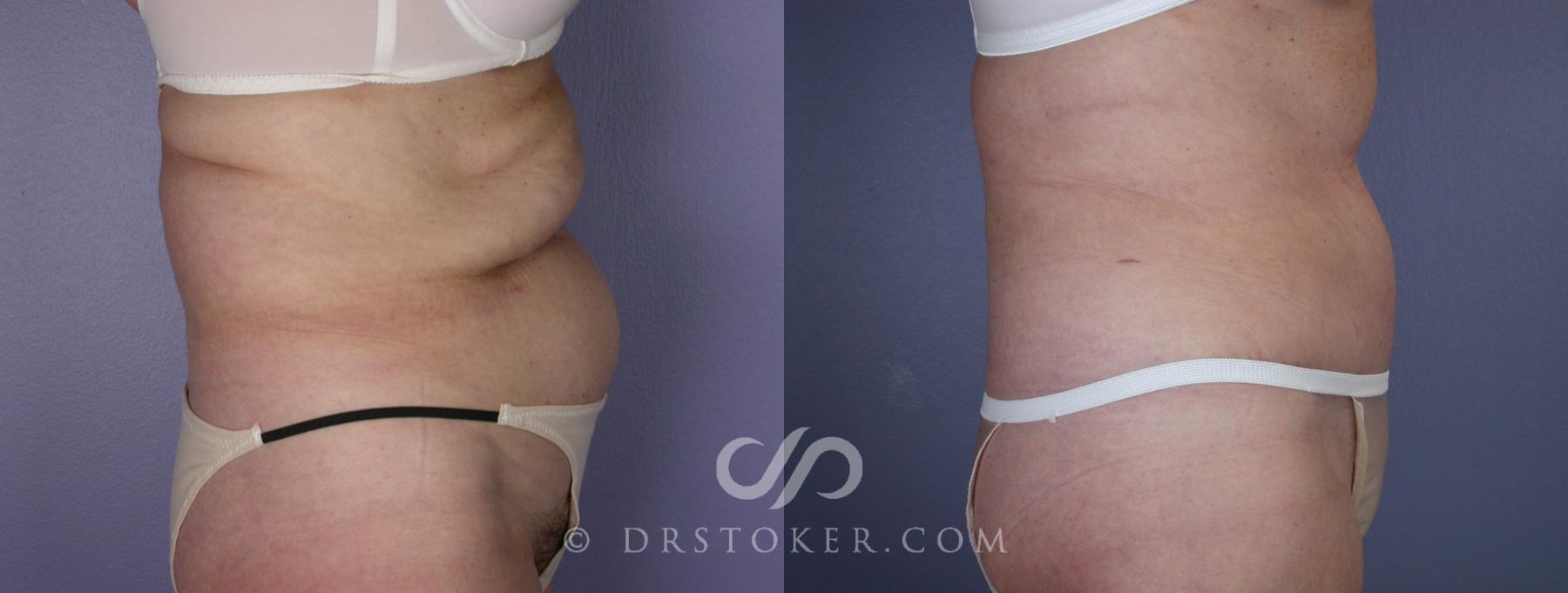 Before & After Tummy Tuck Case 118 View #3 View in Los Angeles, CA