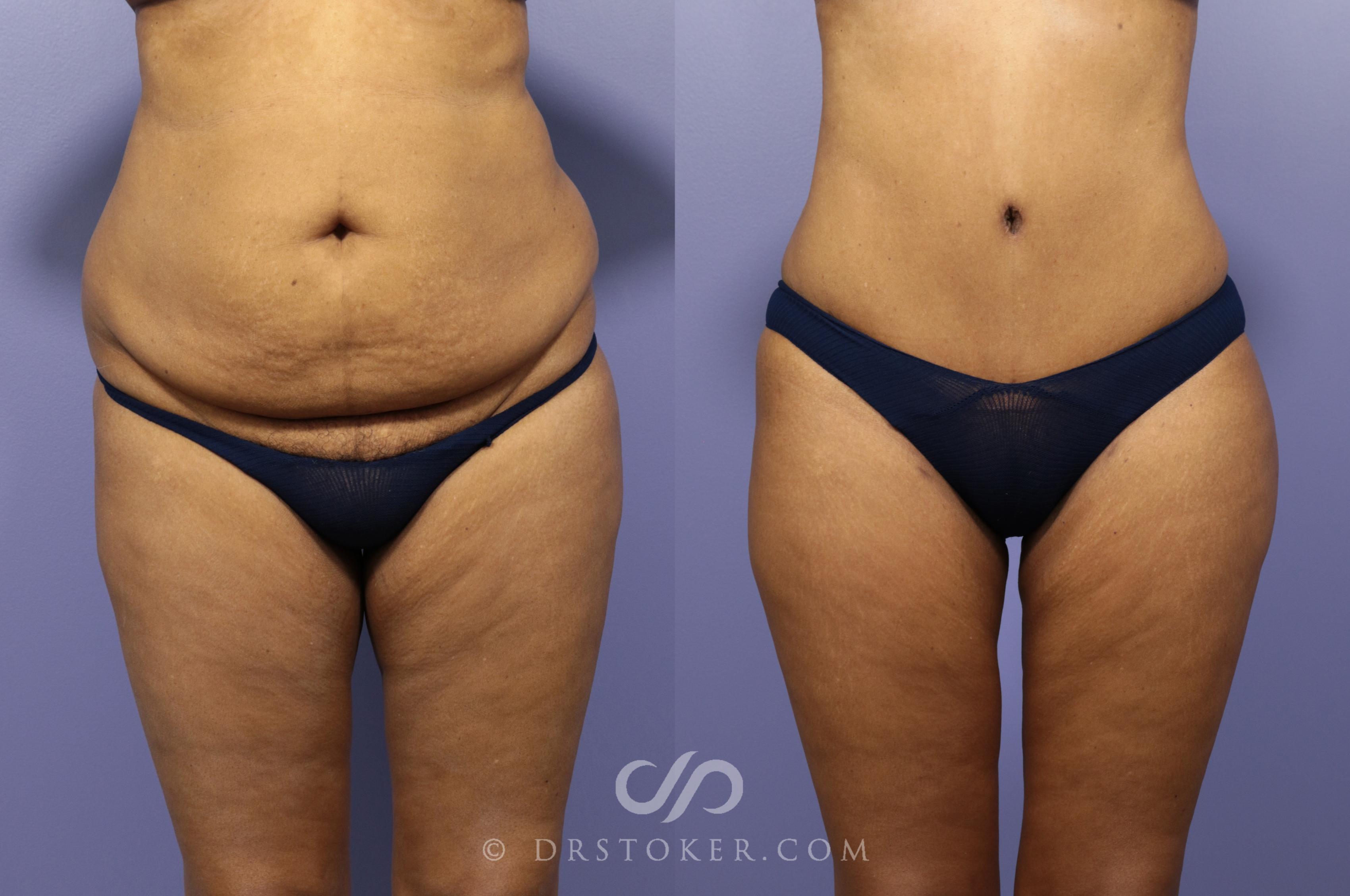 Tummy tuck with lipo on the flanks can create the hourglass shape - Hourglass Tummy Tuck