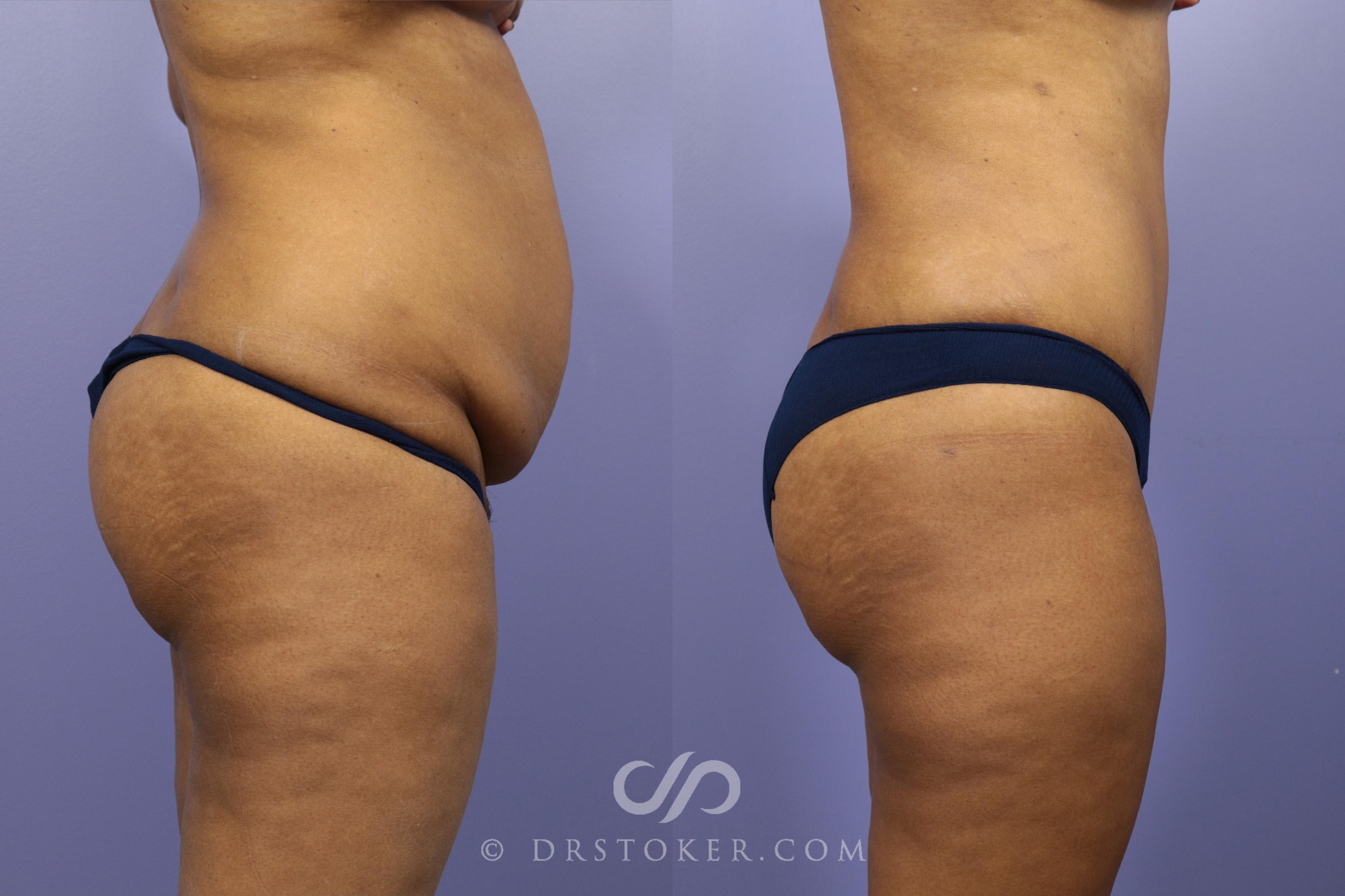 Before & After Tummy Tuck Case 1180 View #2 View in Los Angeles, CA