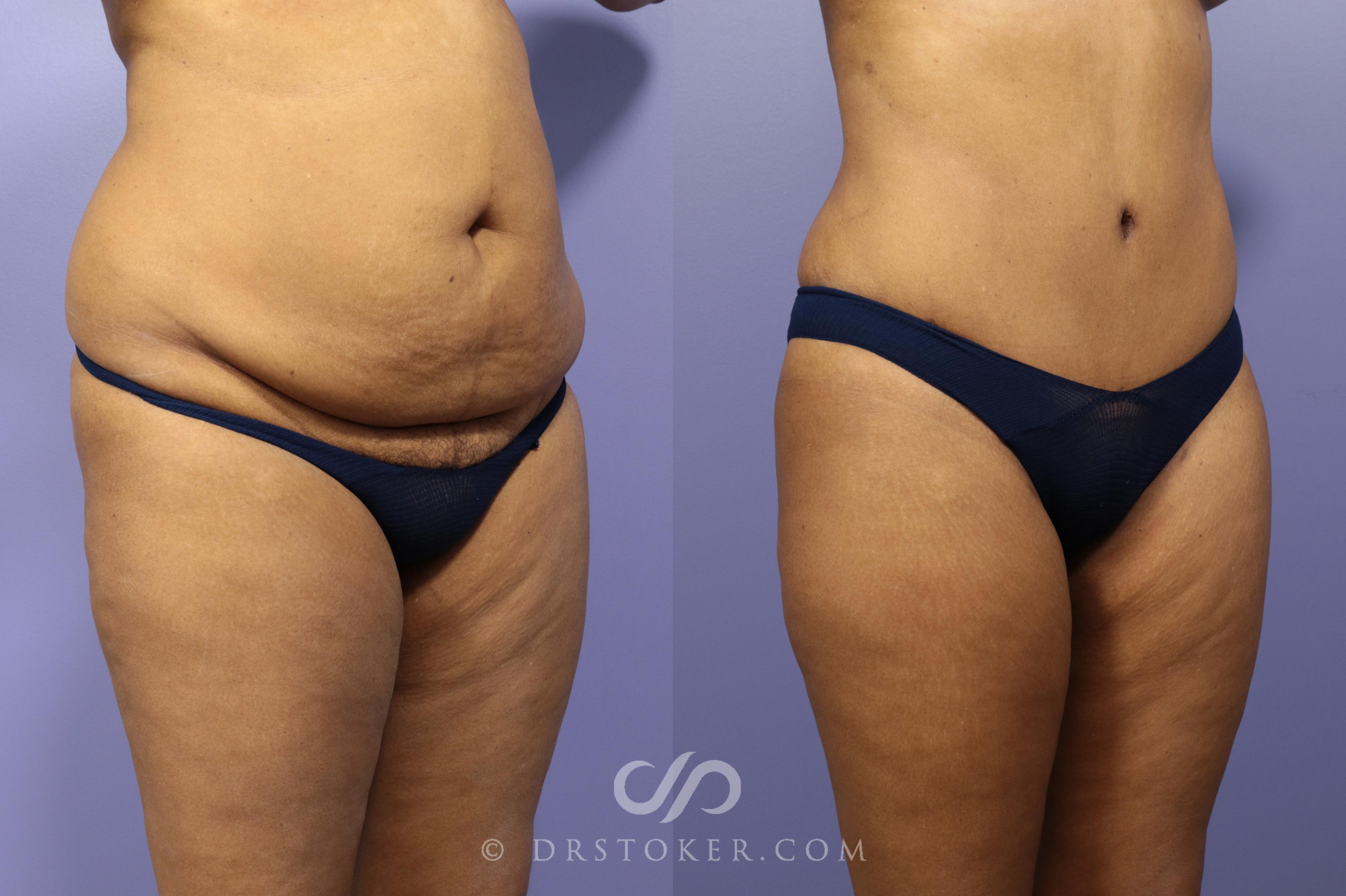 Before & After Tummy Tuck Case 1180 View #3 View in Los Angeles, CA