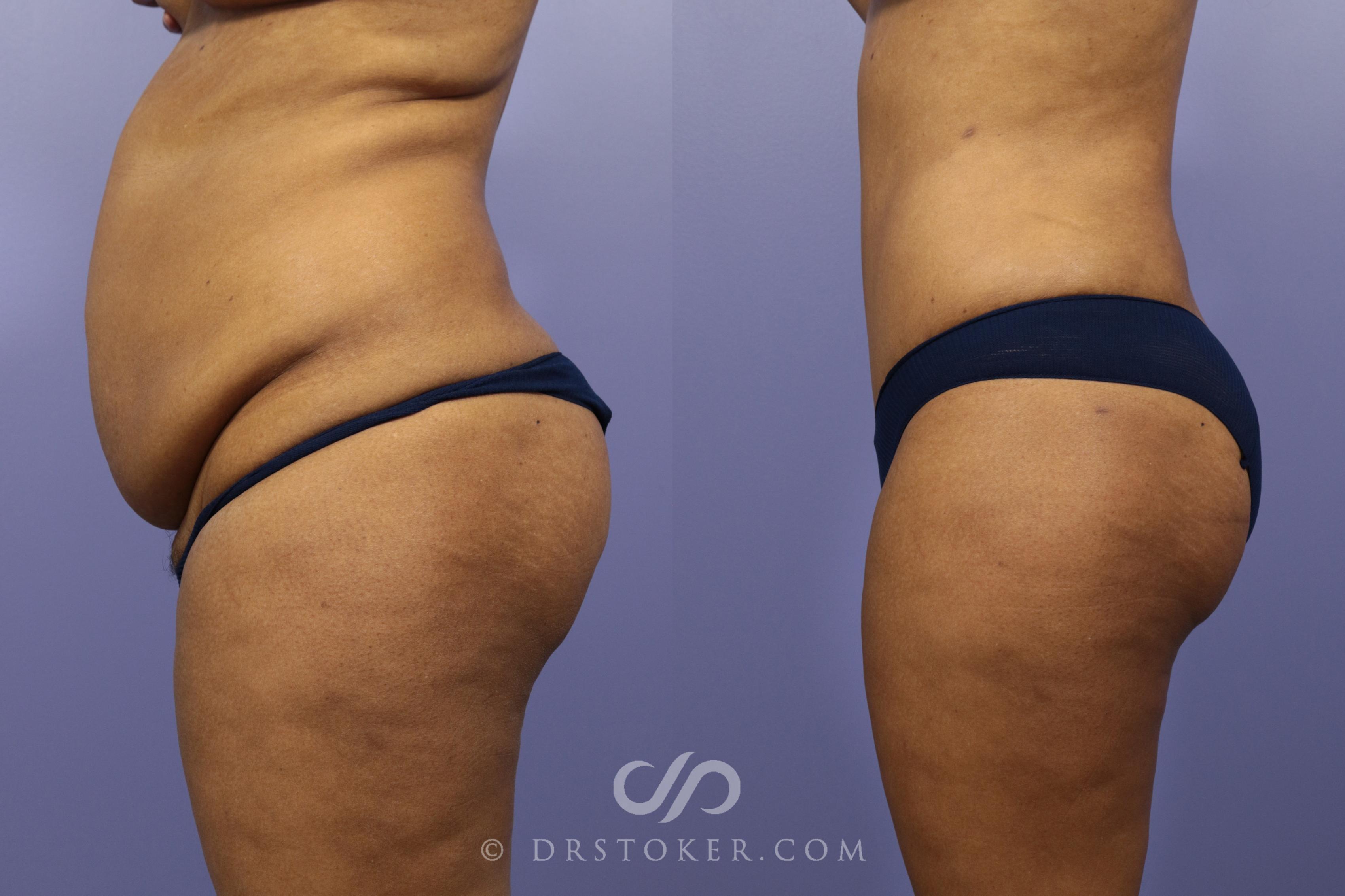 Before & After Tummy Tuck Case 1181 View #1 View in Los Angeles, CA
