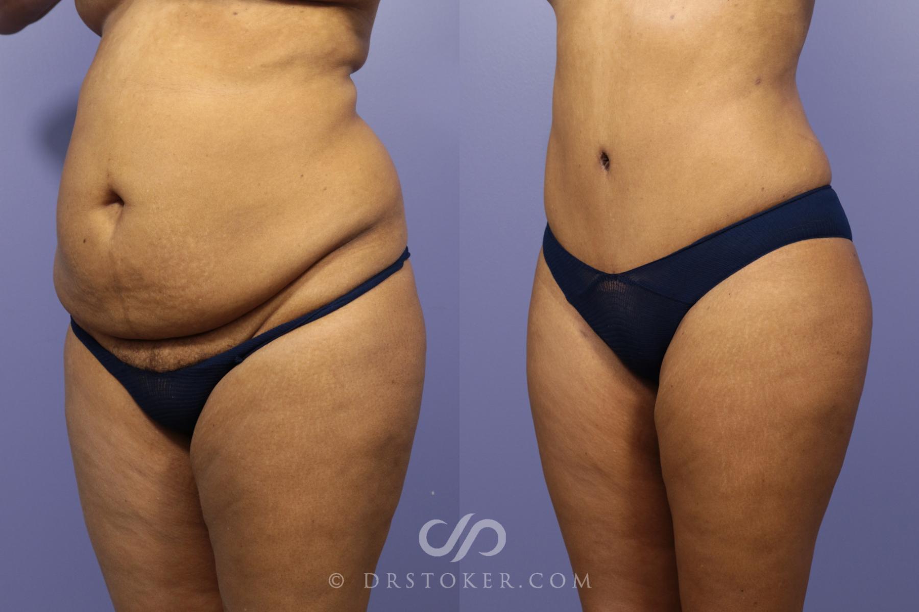Before & After Tummy Tuck Case 1181 View #2 View in Los Angeles, CA