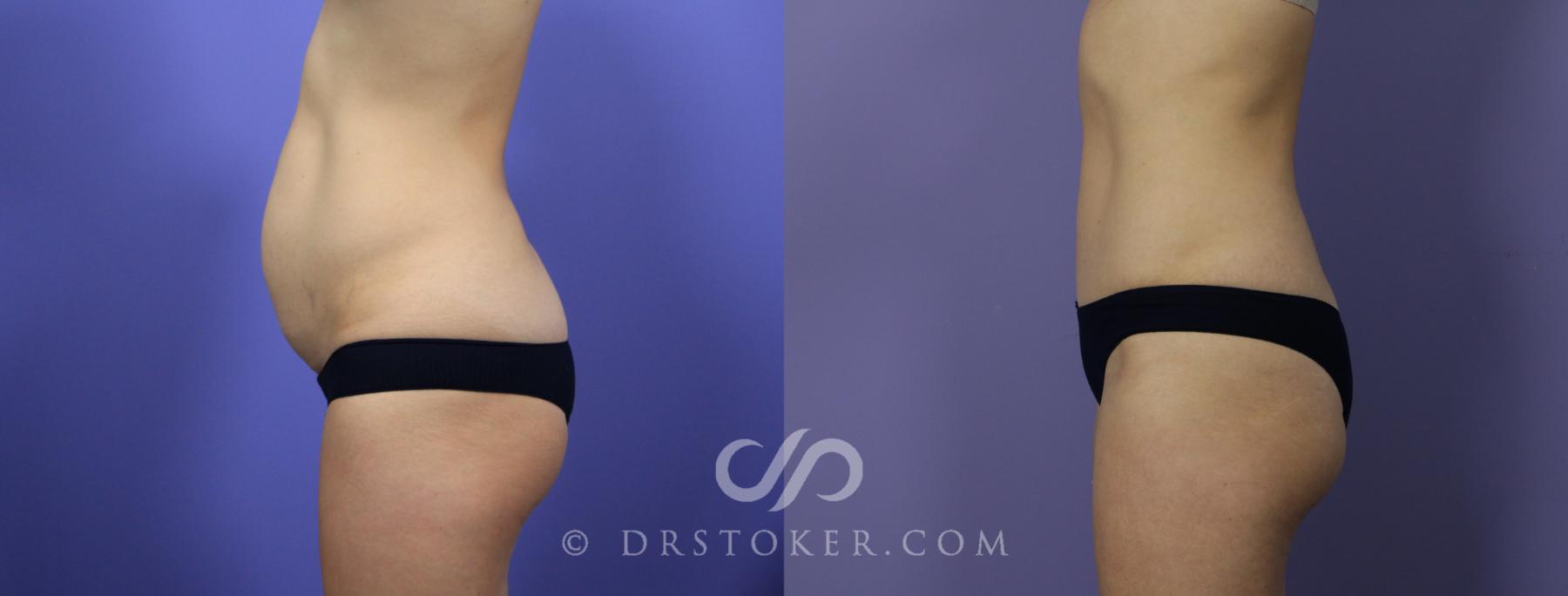 Before & After Tummy Tuck Case 1183 View #2 View in Los Angeles, CA